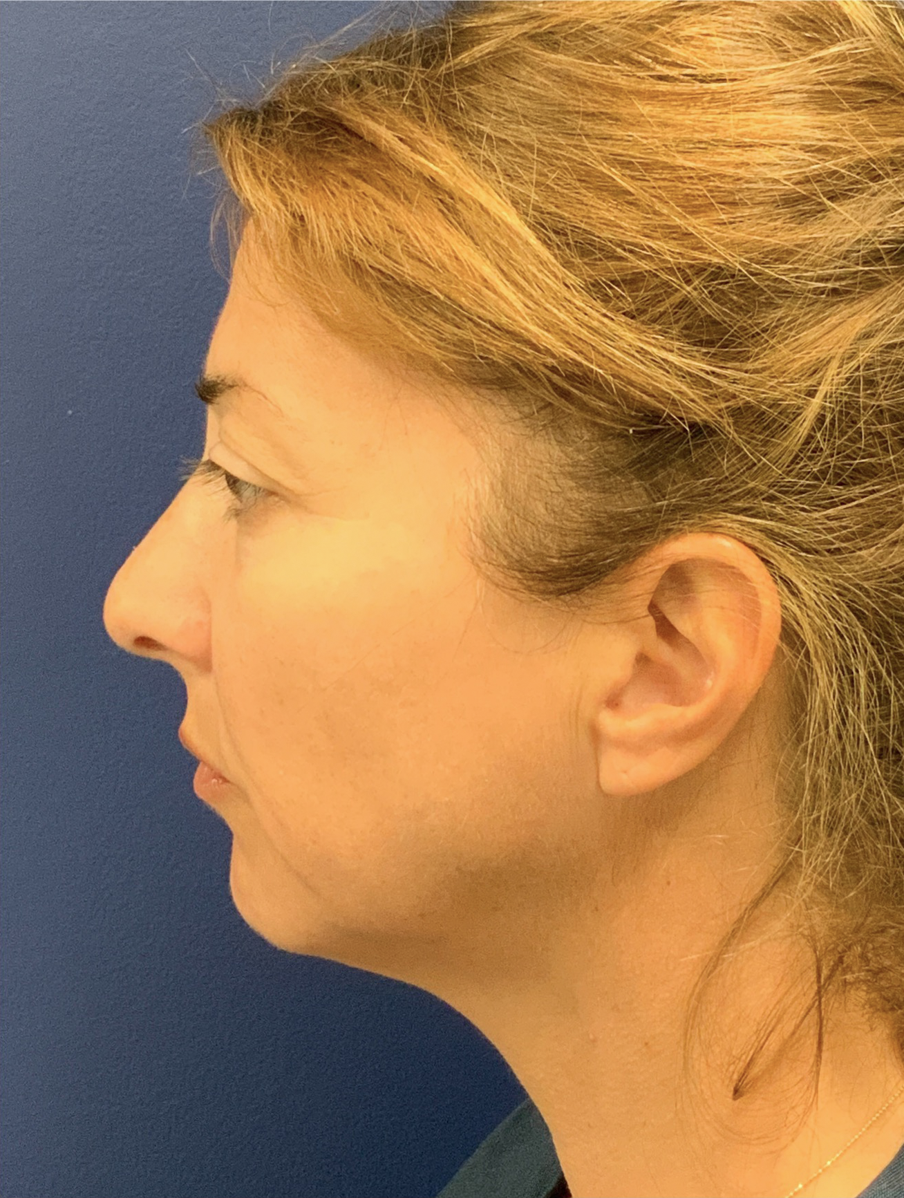 Facelift-360-Facial-Fat-Graft-Blepharoplasty-Neck-Lift-Case--6190 | Before Face360 2