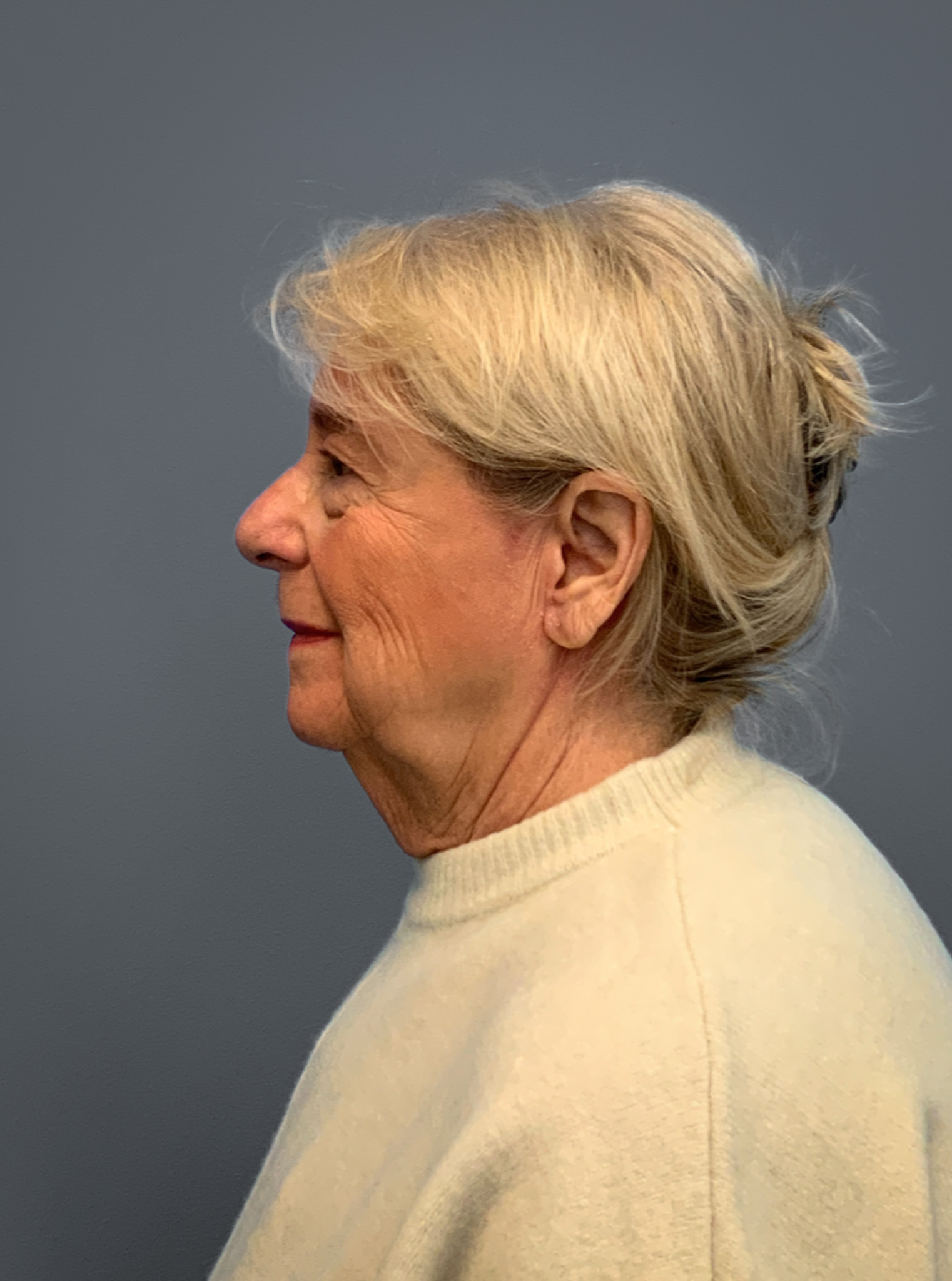 Facelift-360-Facial-Fat-Grafting-and-Necklift-Blepharoplasty-Case--1088 | After Facelift 2
