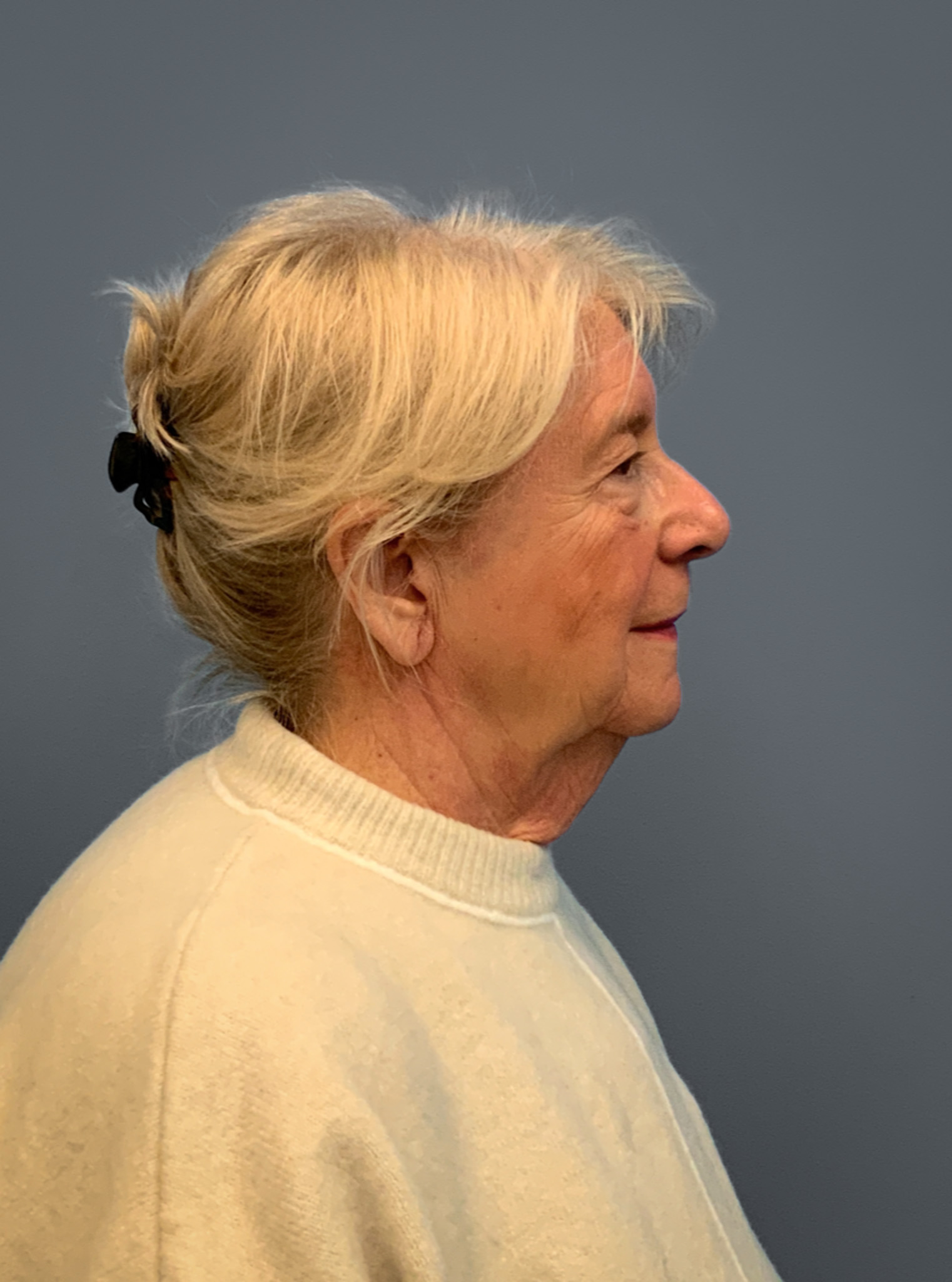 Facelift-360-Facial-Fat-Grafting-and-Necklift-Blepharoplasty-Case--1088 | Before Facelift 2