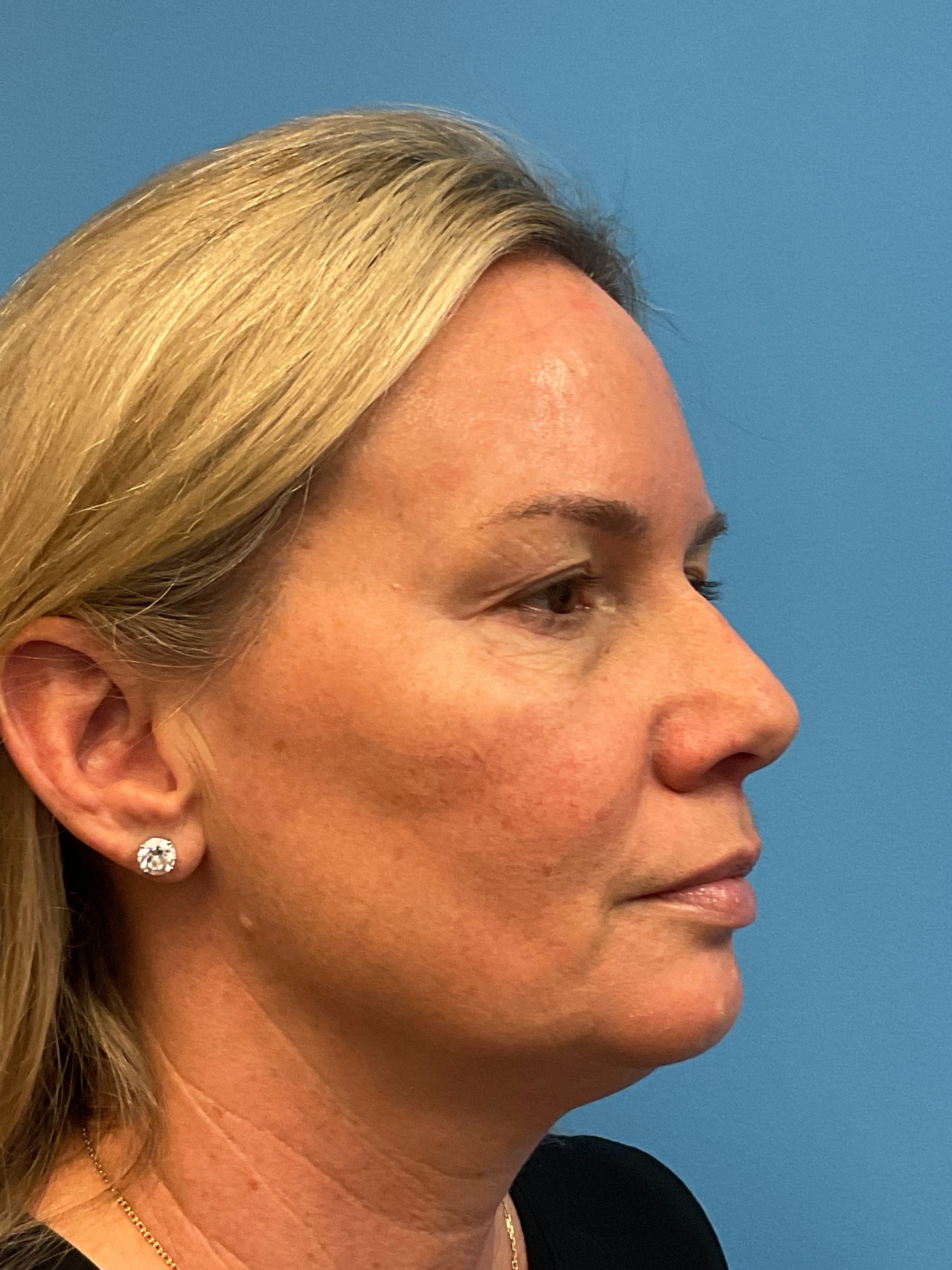 Facelift-Facial-Fat-Grafting-Necklift-Blepharoplasty-Case--9823 | Before Eyelid Surgery 3