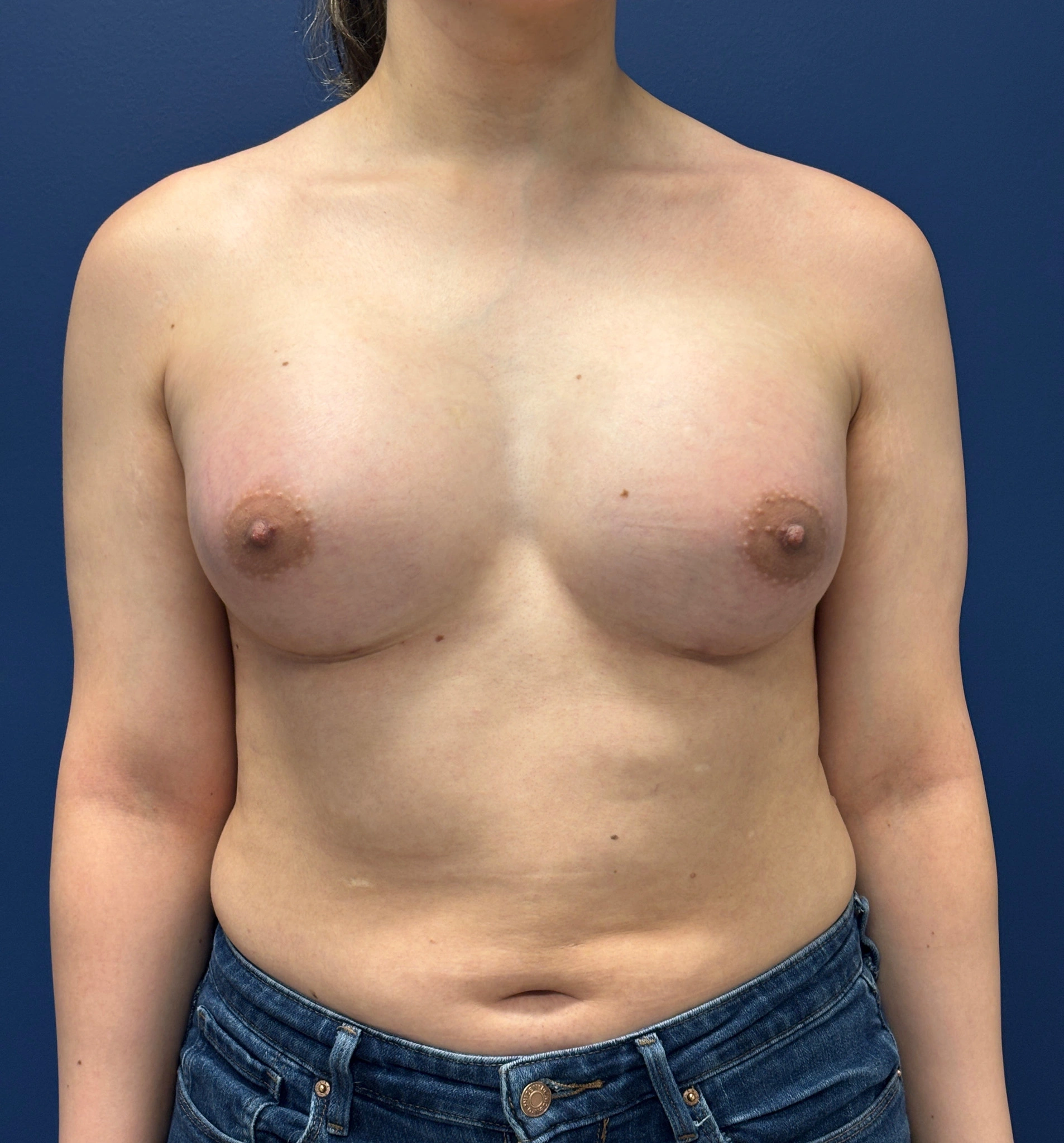 Breast-Augmentation-Case--2719 | After Breast 1