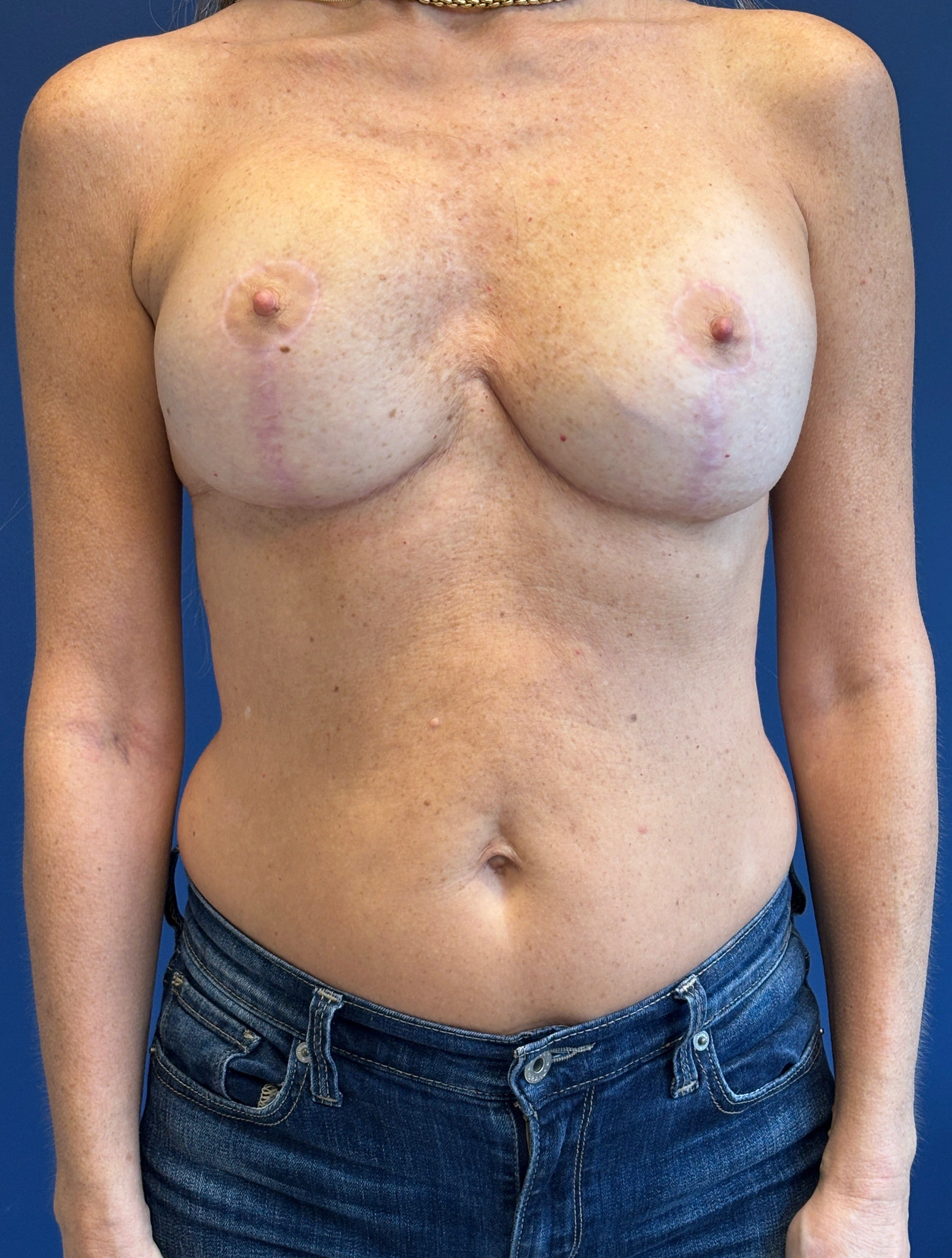 Breast-Reconstruction-Case--8978 | After Breast 1