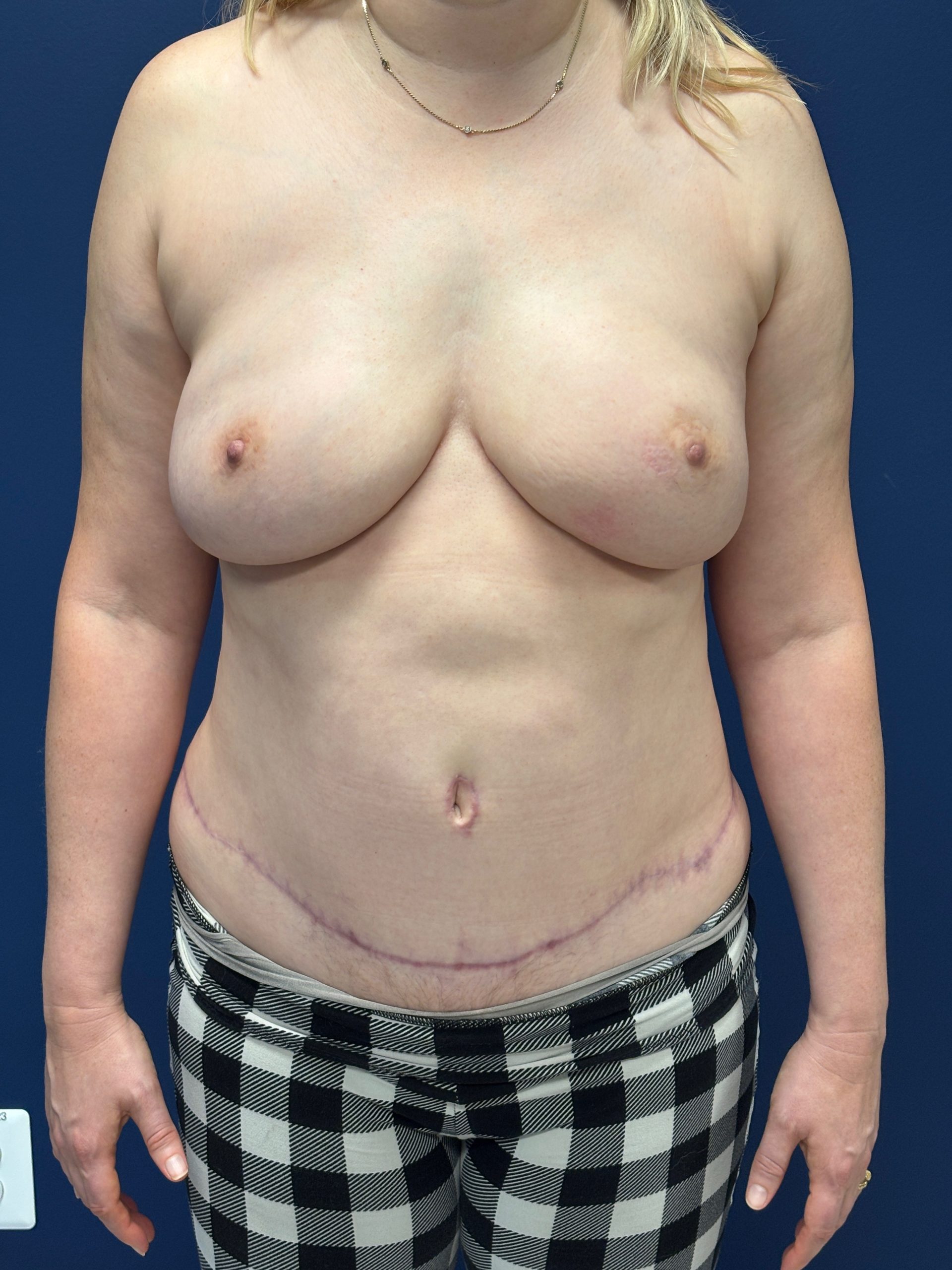 Revision-Breast-Reconstruction-Case--9545 | After Breast 1