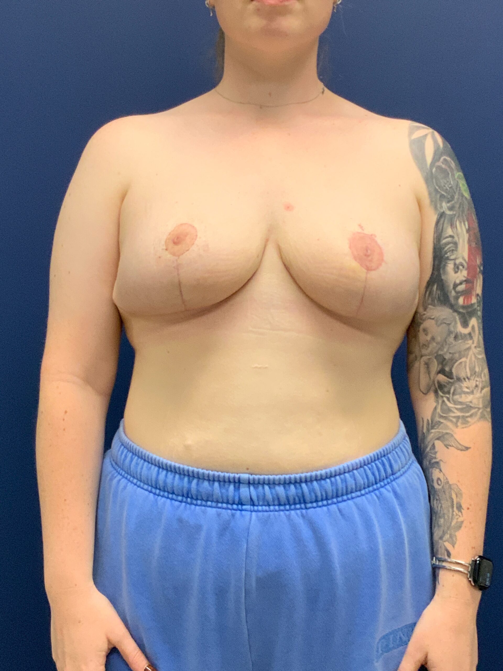 Breast-Reduction-Case--2527 | After Breast 1