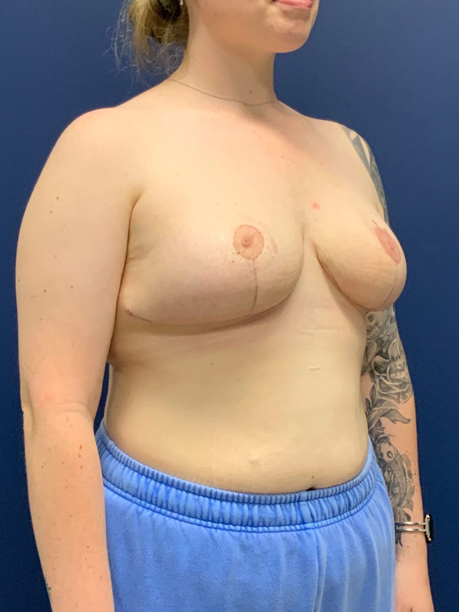 Breast-Reduction-Case--2527 | After Breast 2