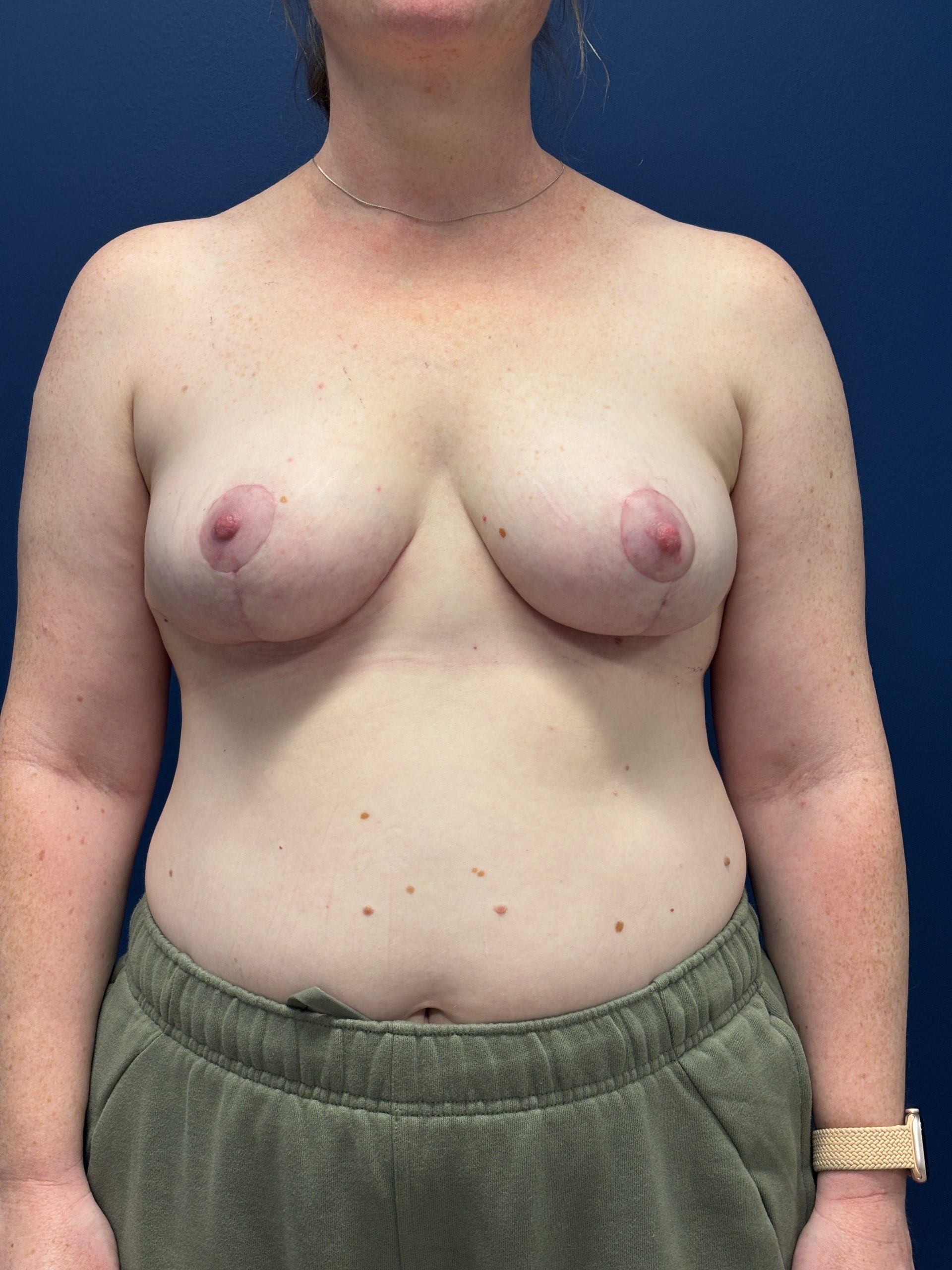 Breast-Reduction-Case--5738 | After Breast 1