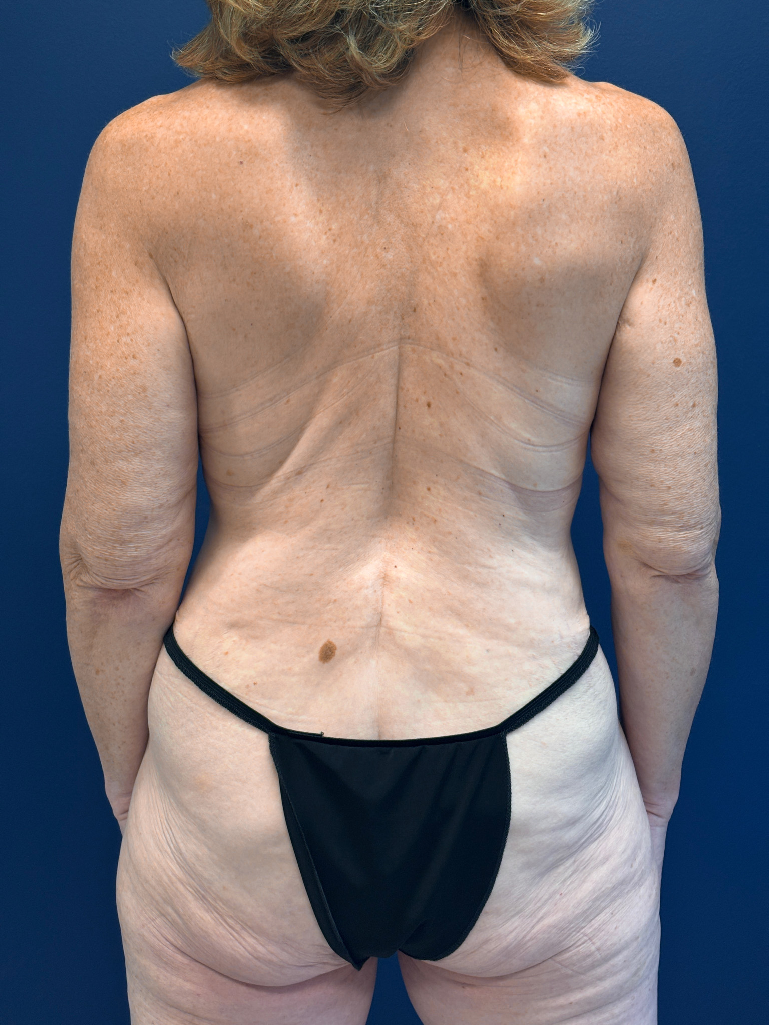 Abdominoplasty-Case--7412 | After Tummy Tuck 6