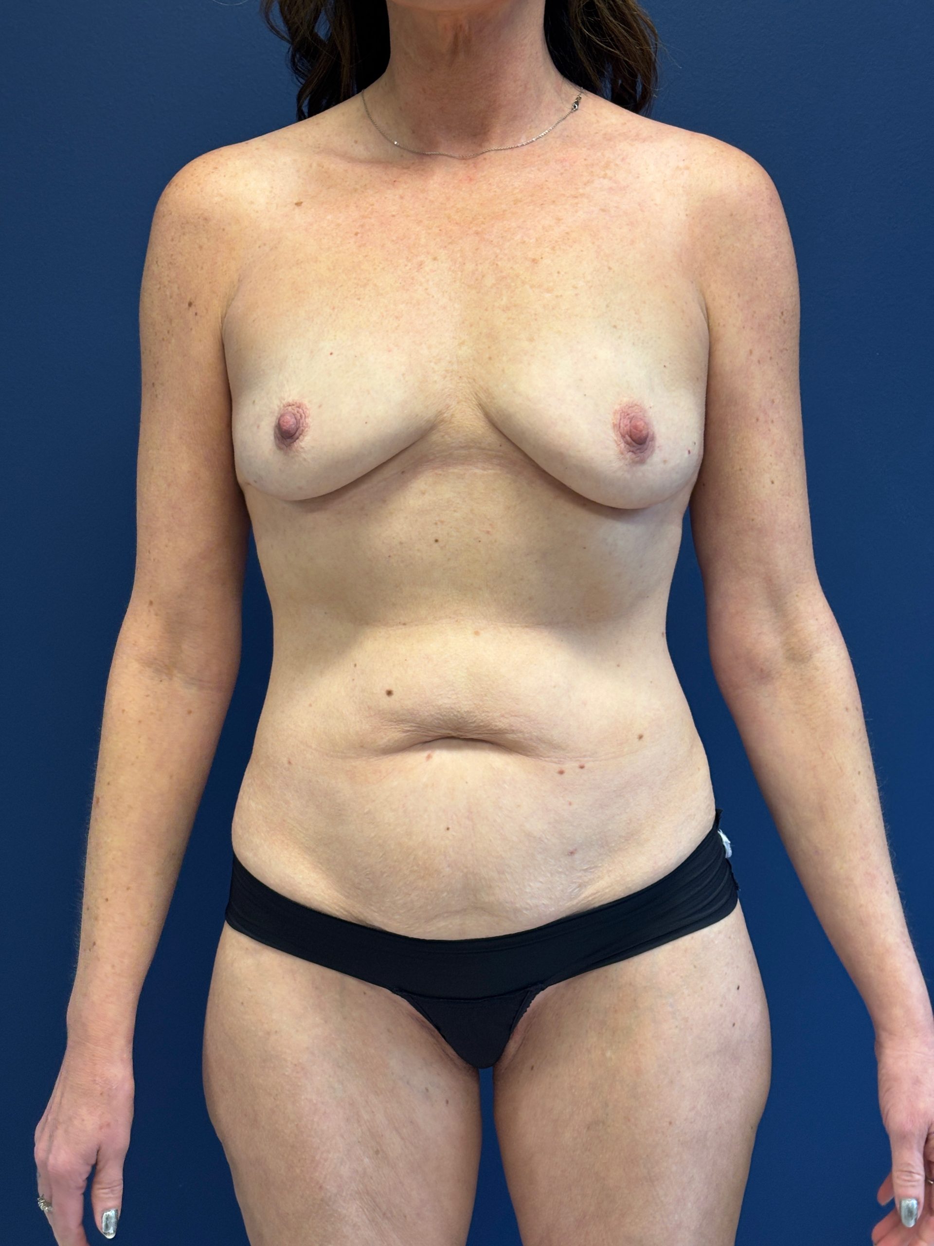 Breast-Augmentation-Case--3669 | Before Breast 1