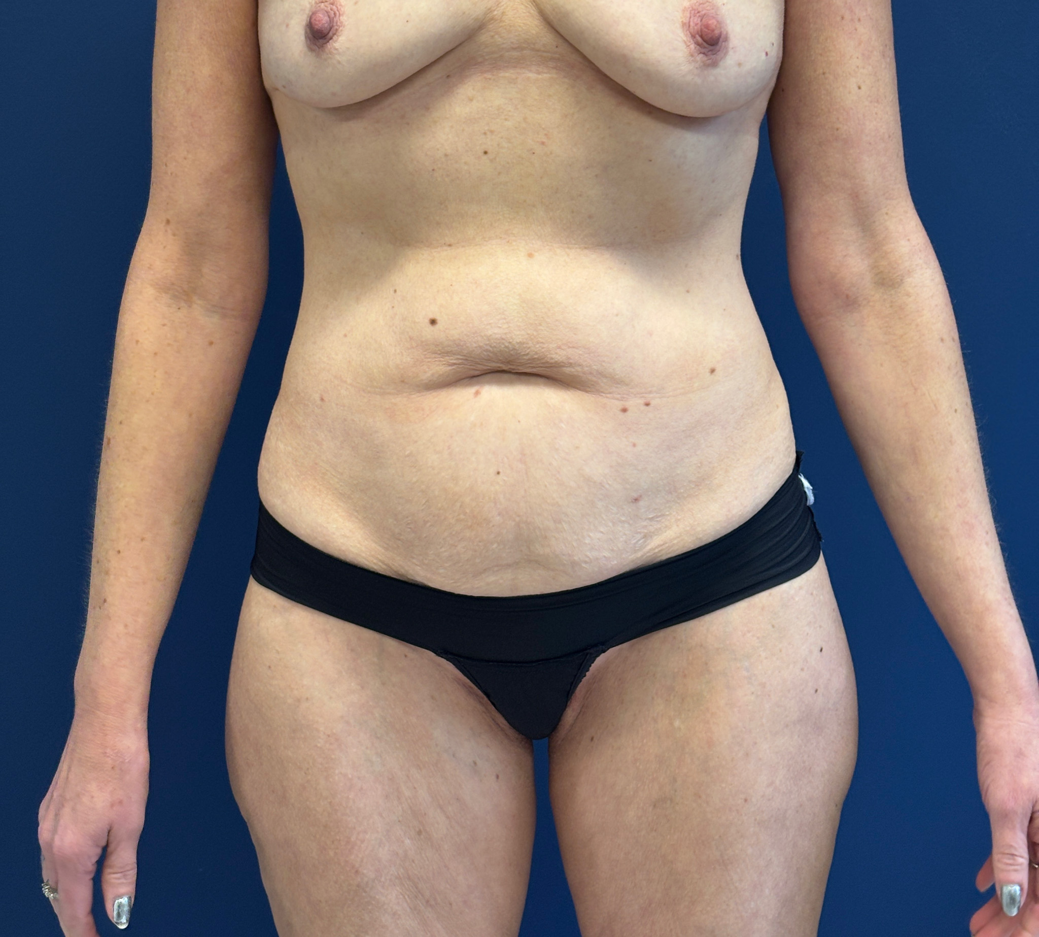 Liposuction-Case--3054 | Before Liposuction 1
