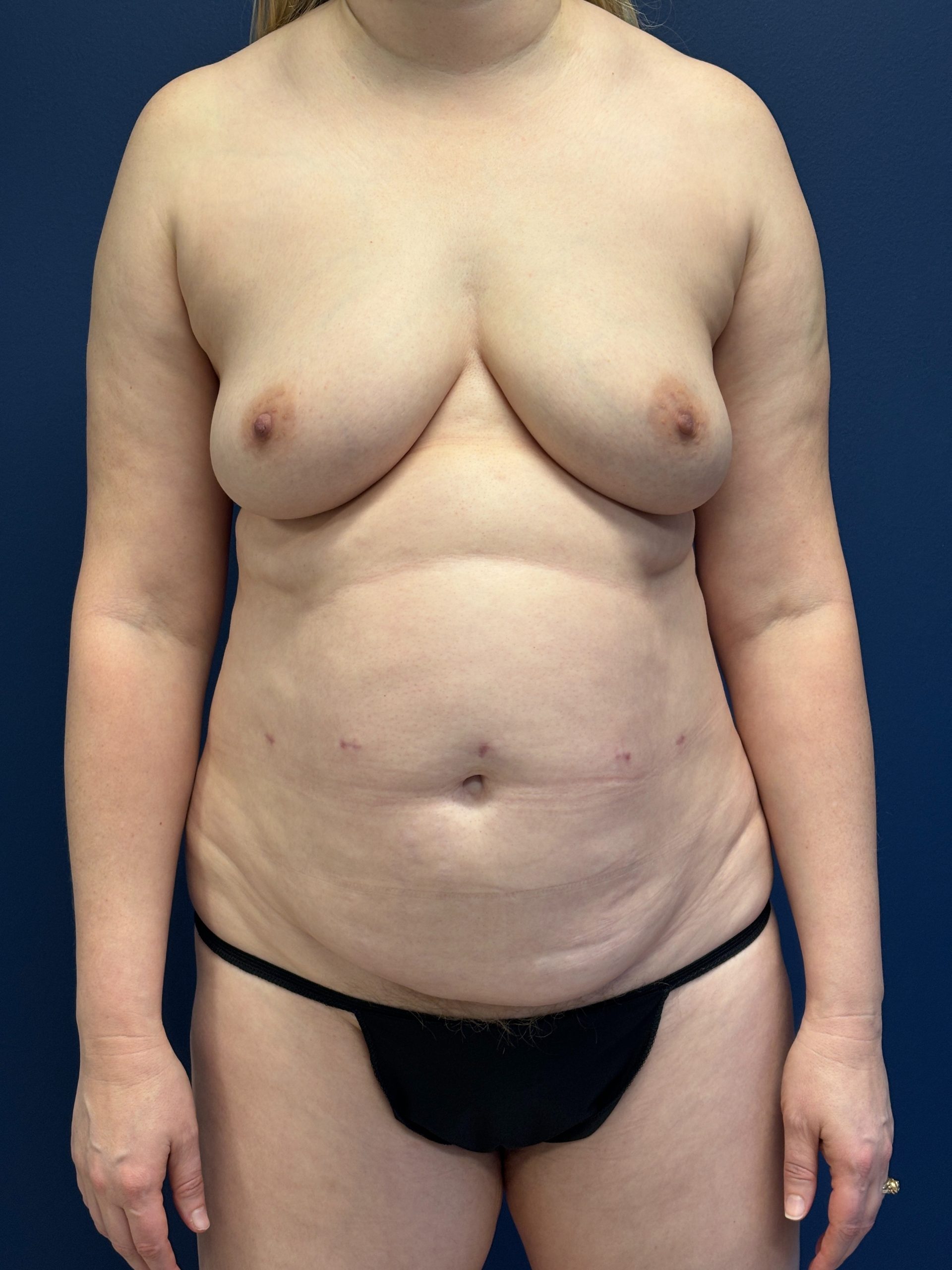 Revision-Breast-Reconstruction-Case--9545 | Before Breast 1