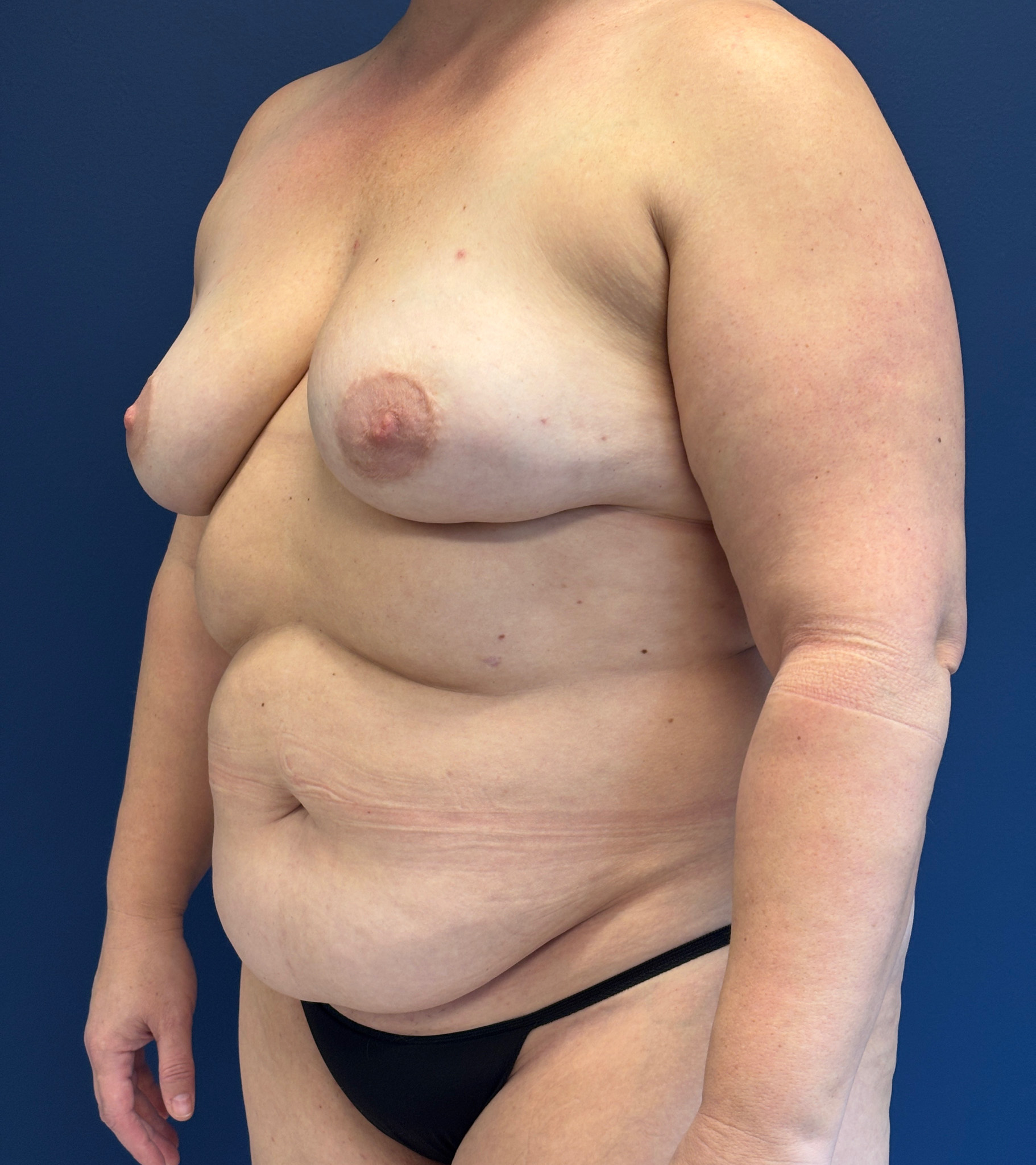 DIEP-Flap-Case--1682 | Before Breast 2