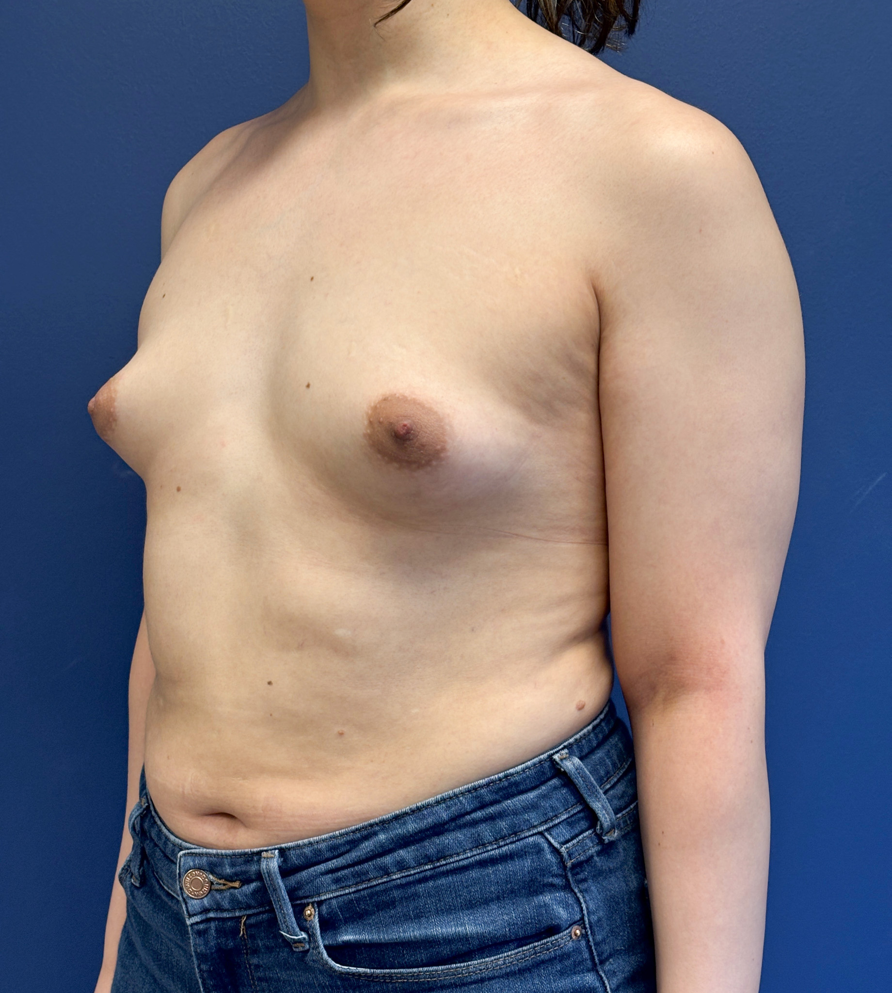 Breast-Augmentation-Case--2719 | Before Breast Augmentation 4