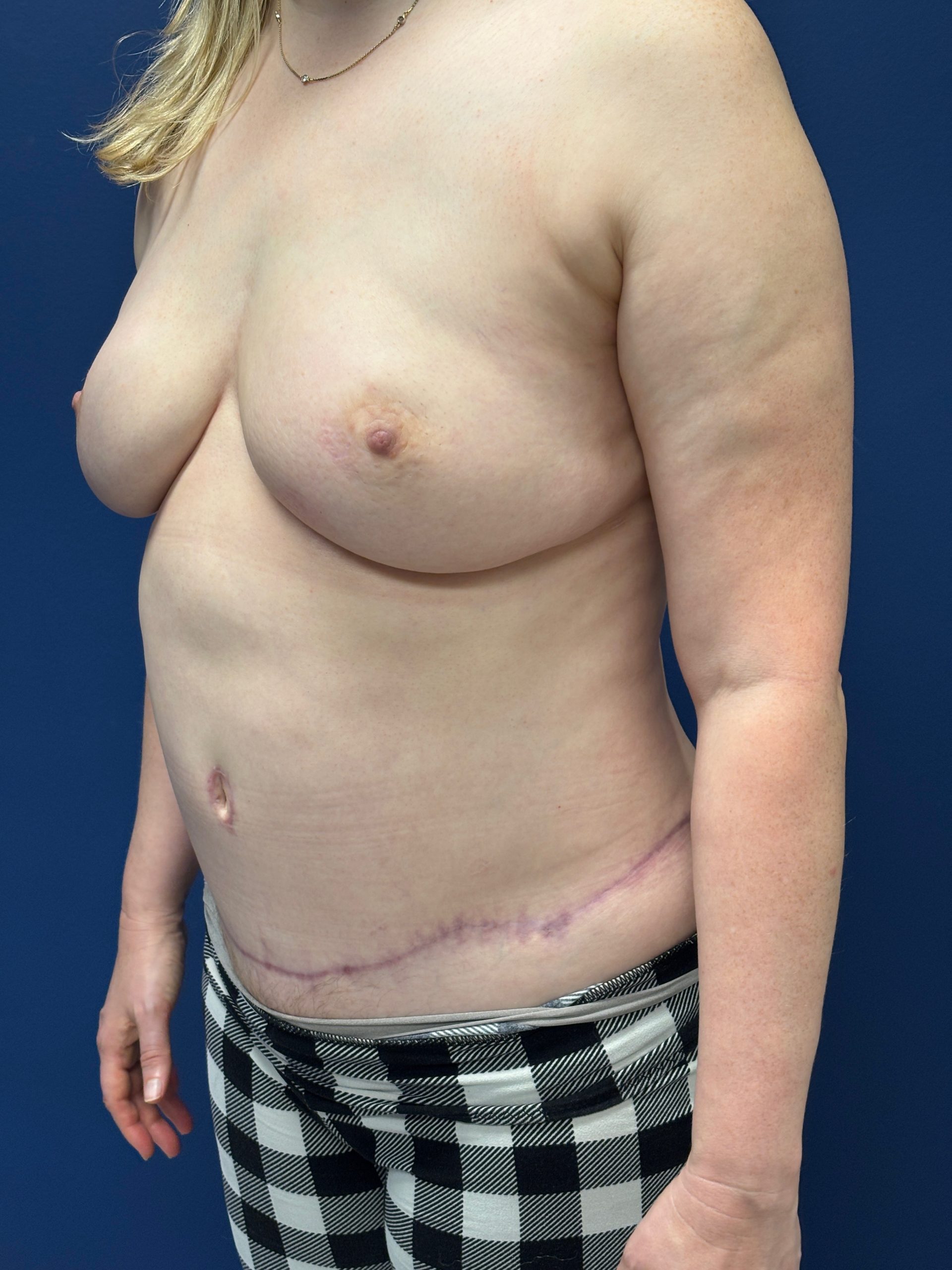 Lipoabdominoplasty-Case--3335 | After Liposuction 4