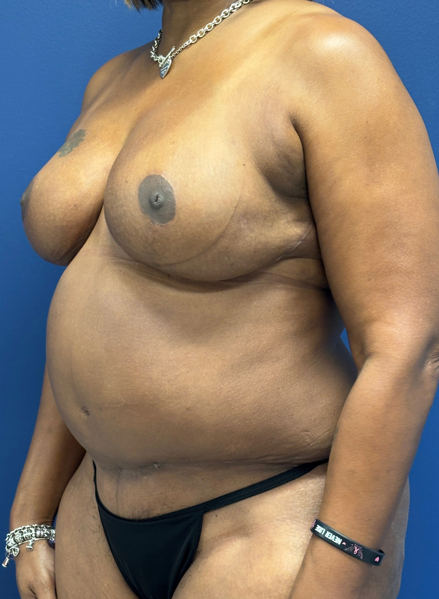 Breast-Reduction-Case--4053 | After Breast 2