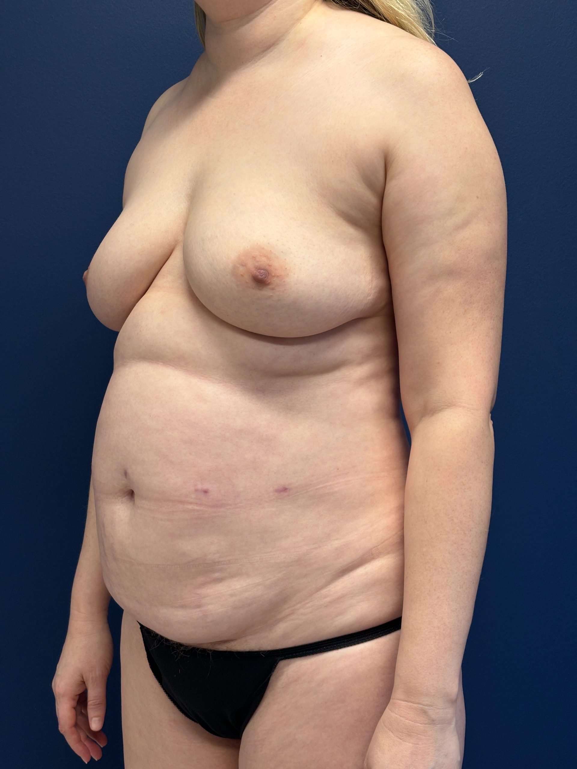 Lipoabdominoplasty-Case--3335 | Before Liposuction 4