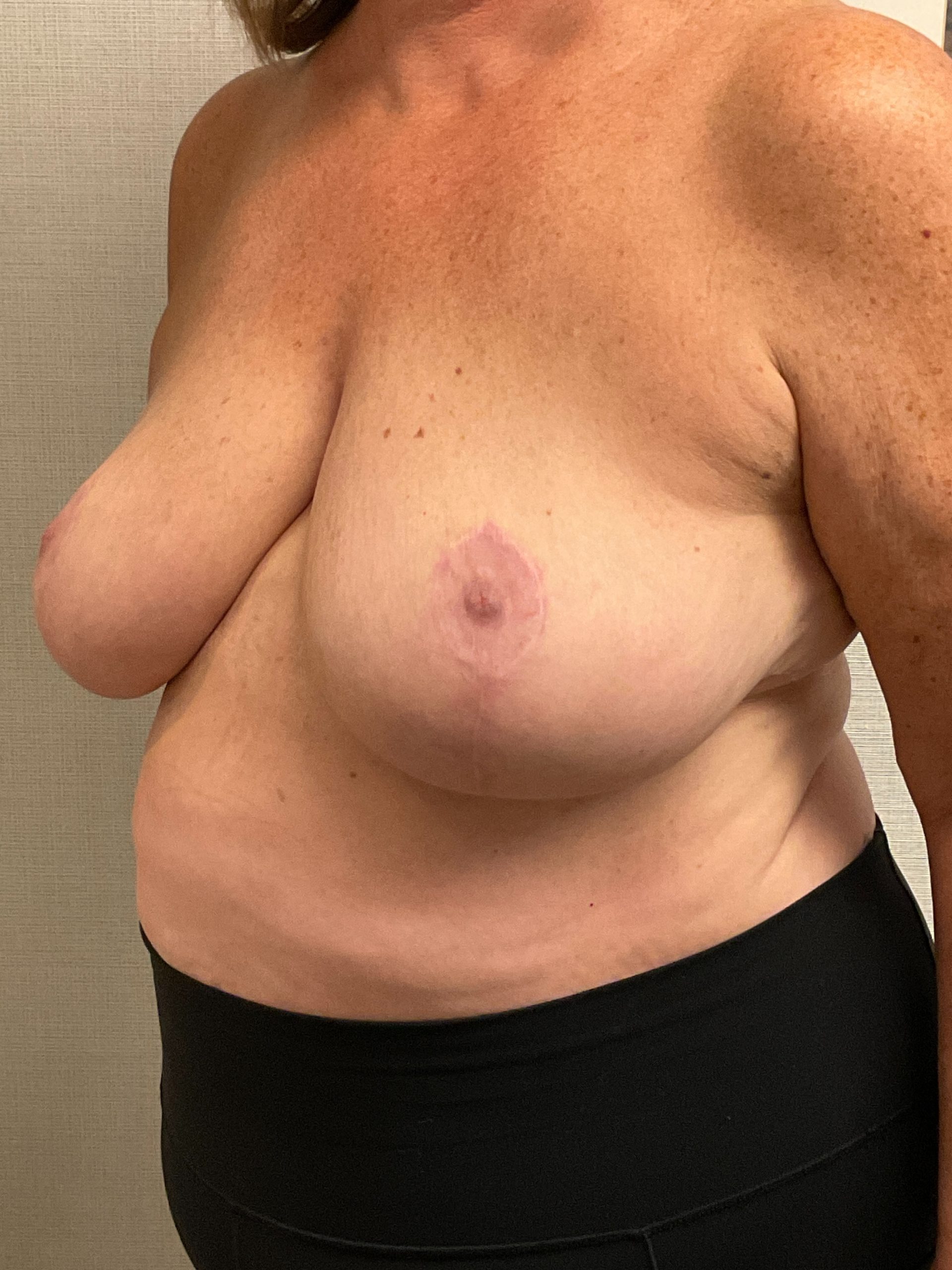 Breast-Reduction-Case--26425 | After Breast Reduction 4
