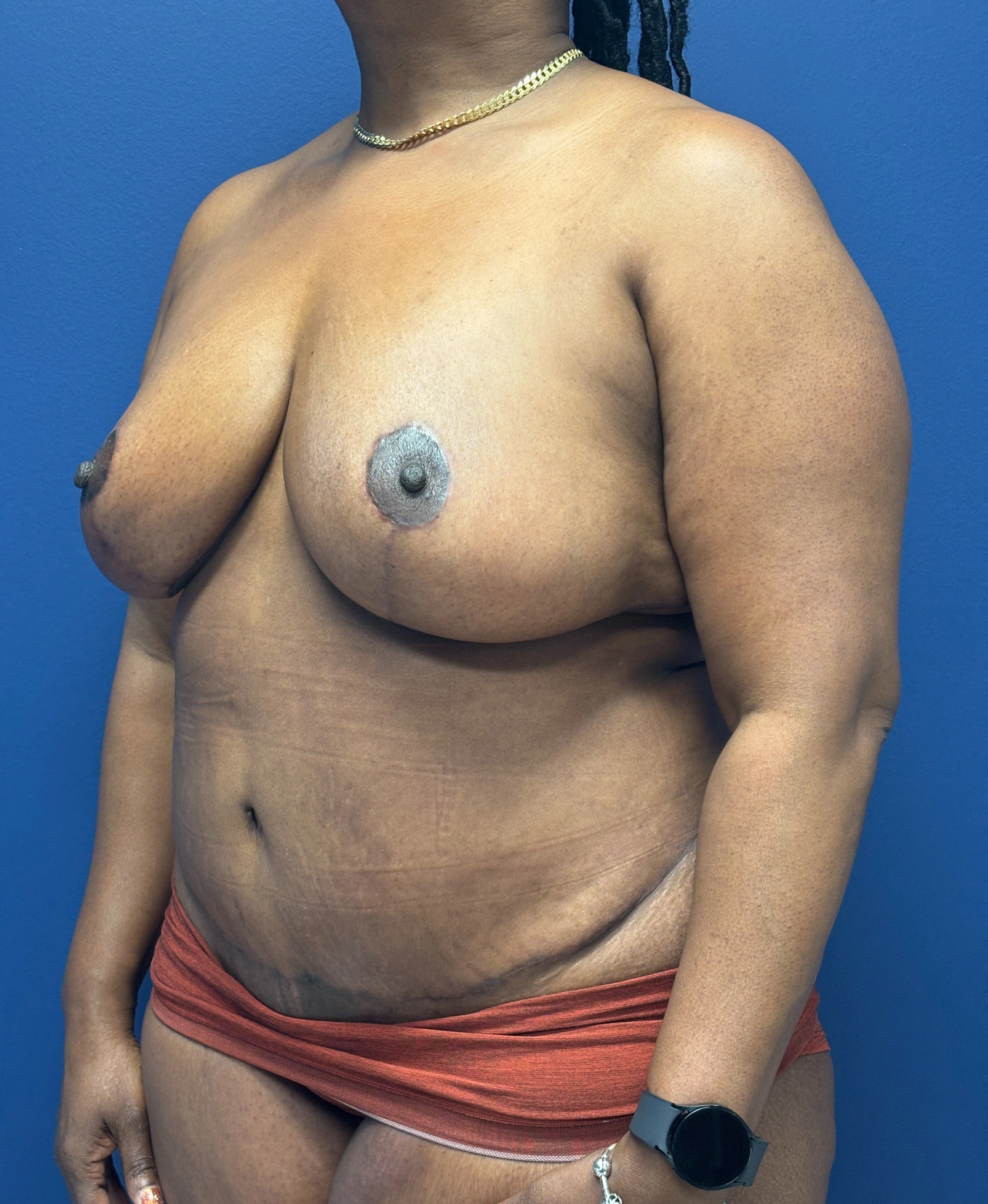 Abdominoplasty-Case--5907 | After Tummy Tuck 4