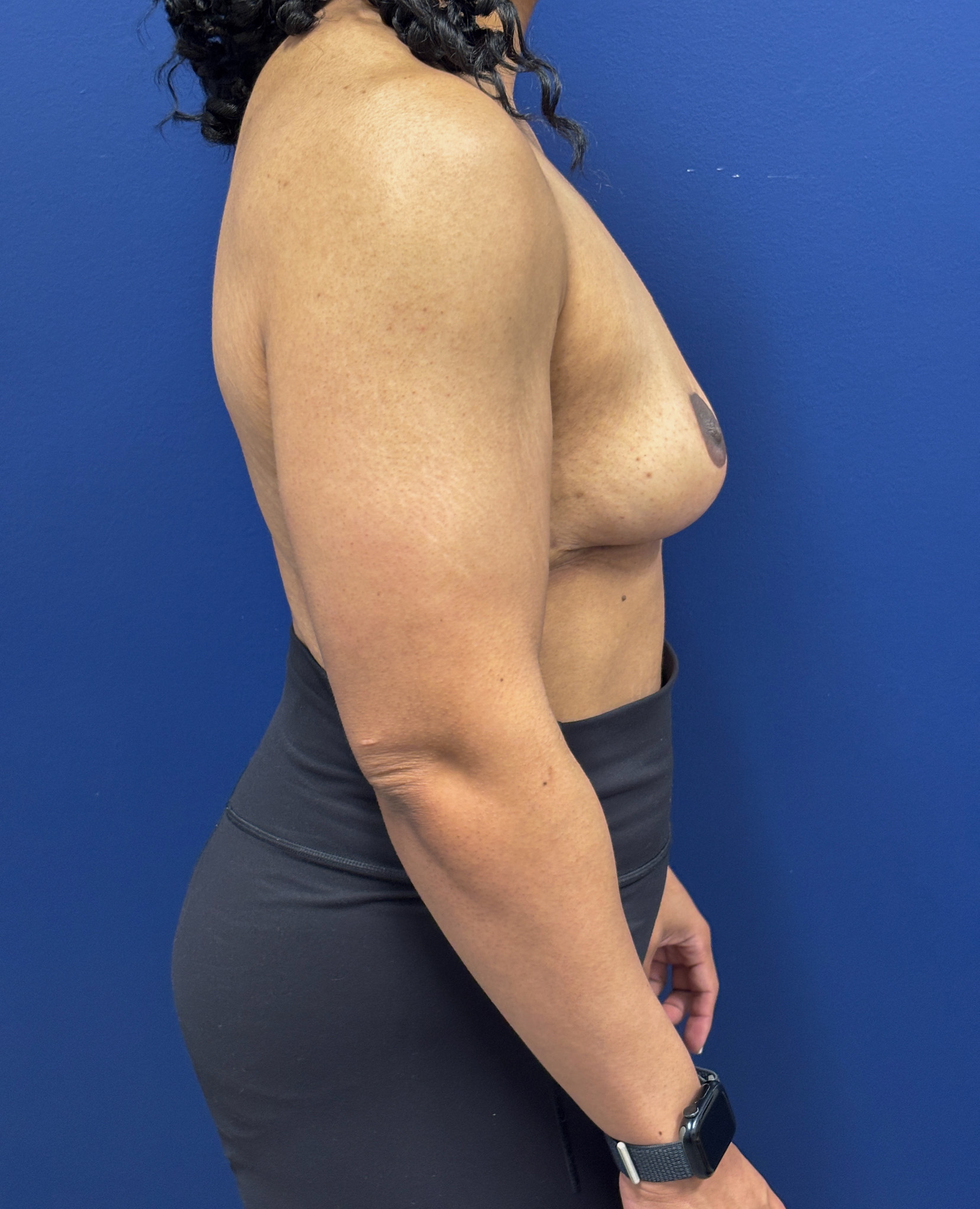 Breast-Reduction-Case--7345 | After Breast 2