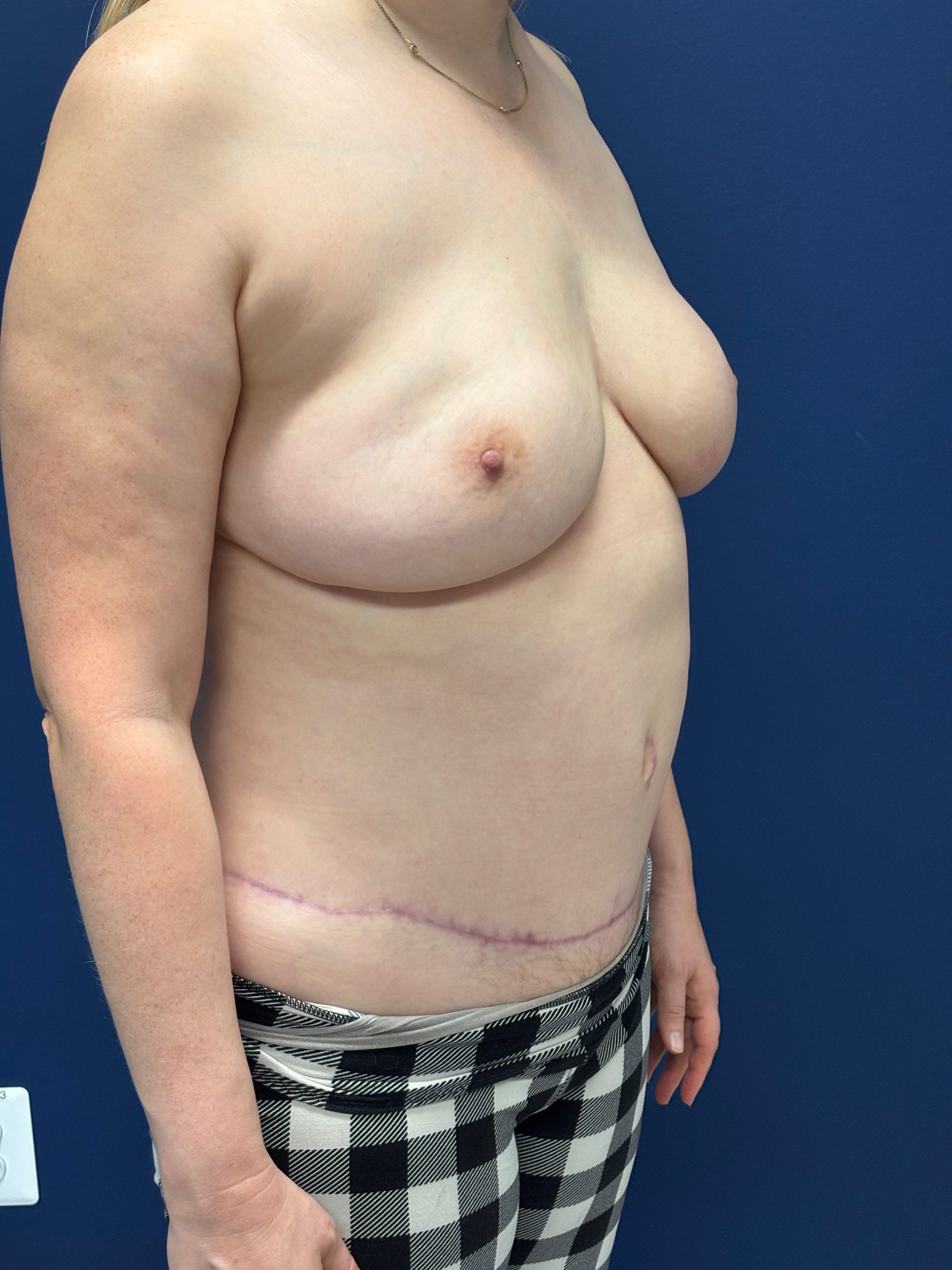 Lipoabdominoplasty-Case--3335 | After Liposuction 5