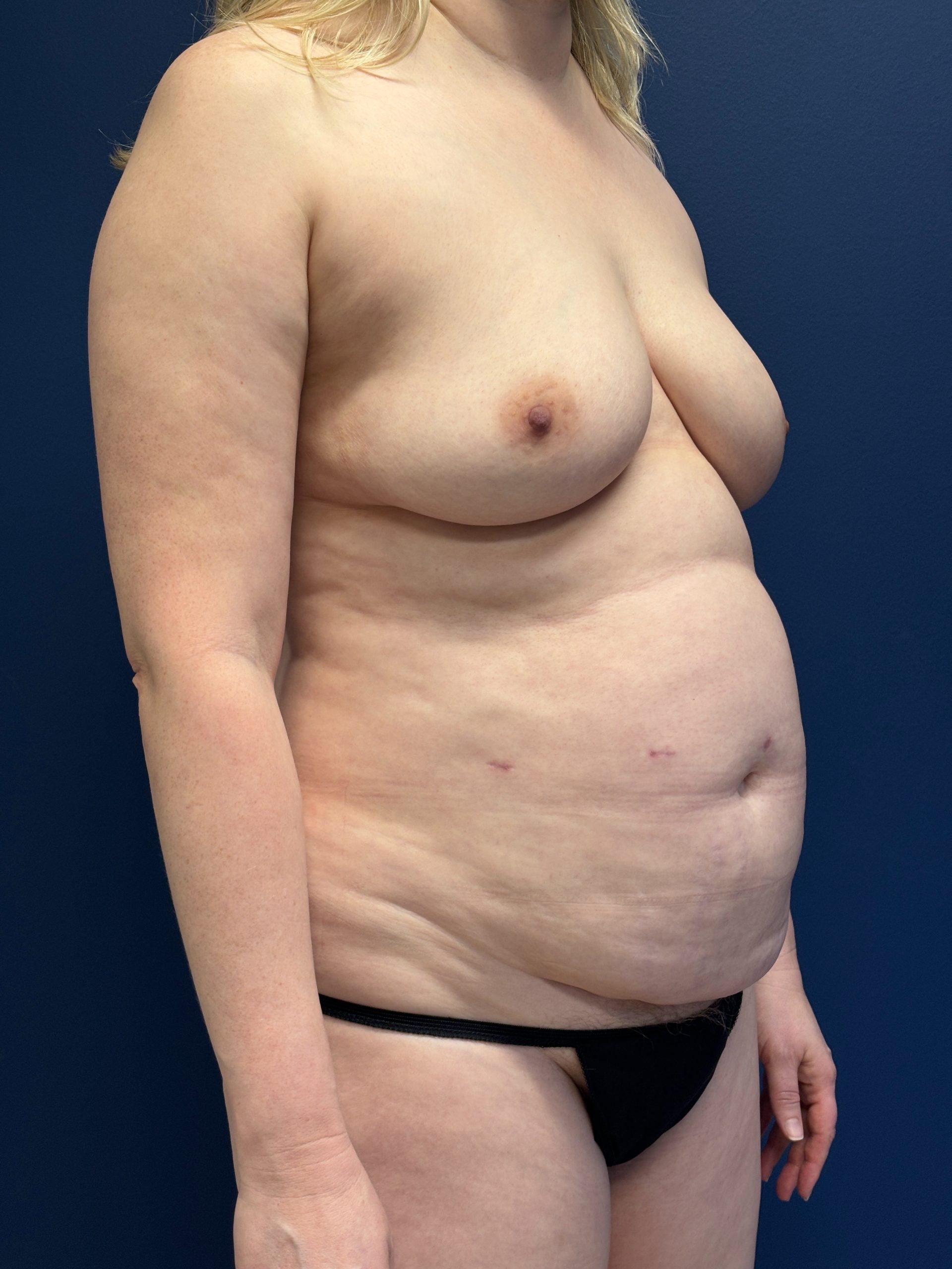 Lipoabdominoplasty-Case--3335 | Before Liposuction 5