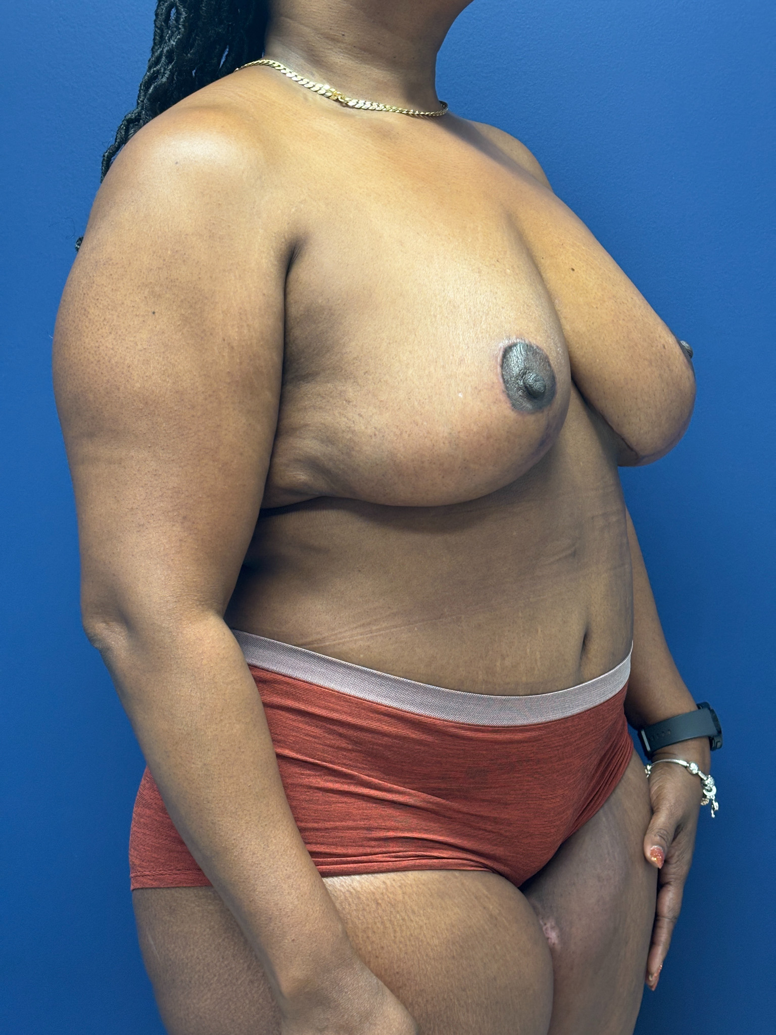 Abdominoplasty-Case--5907 | After Tummy Tuck 5