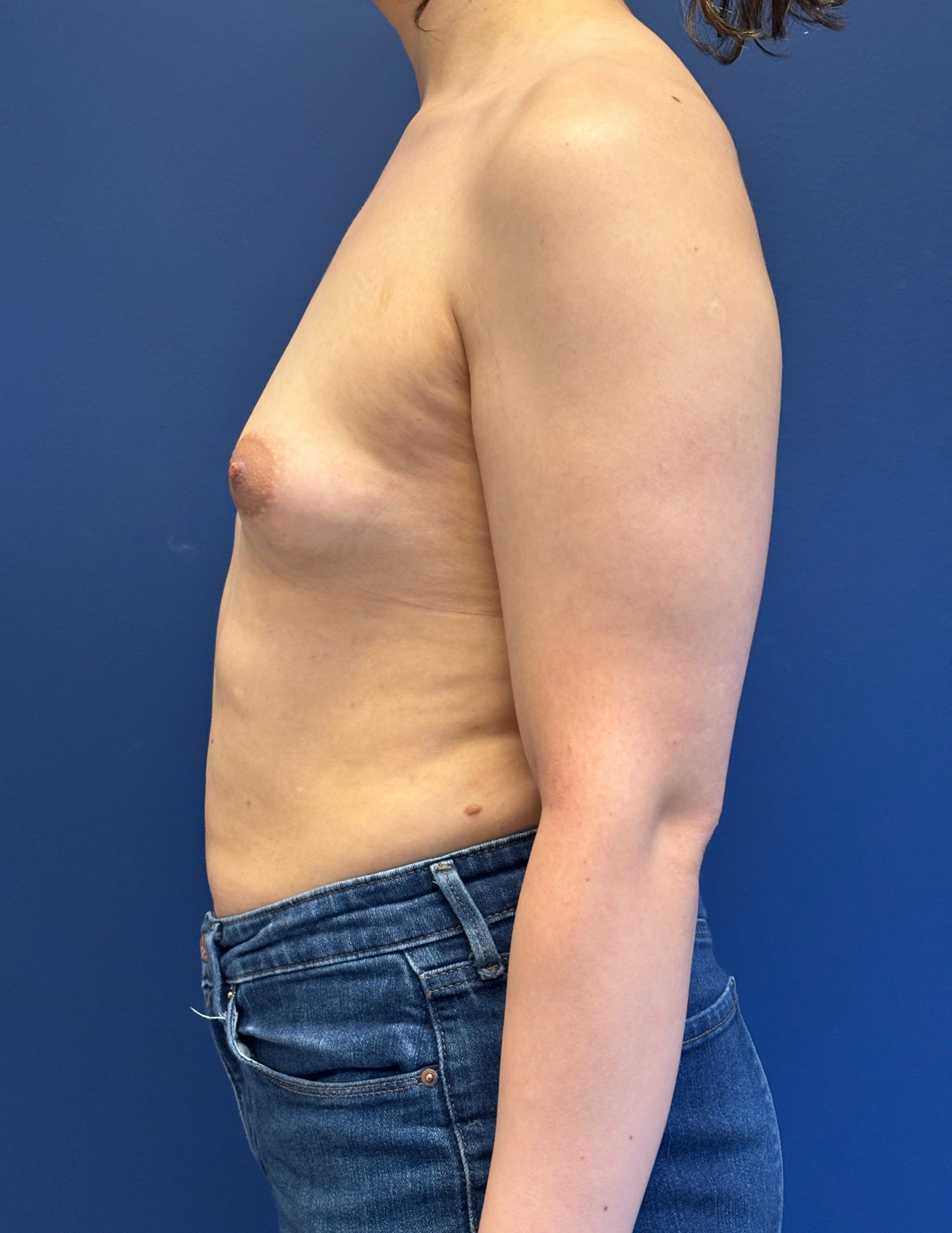 Breast-Augmentation-Case--2719 | Before Breast 2