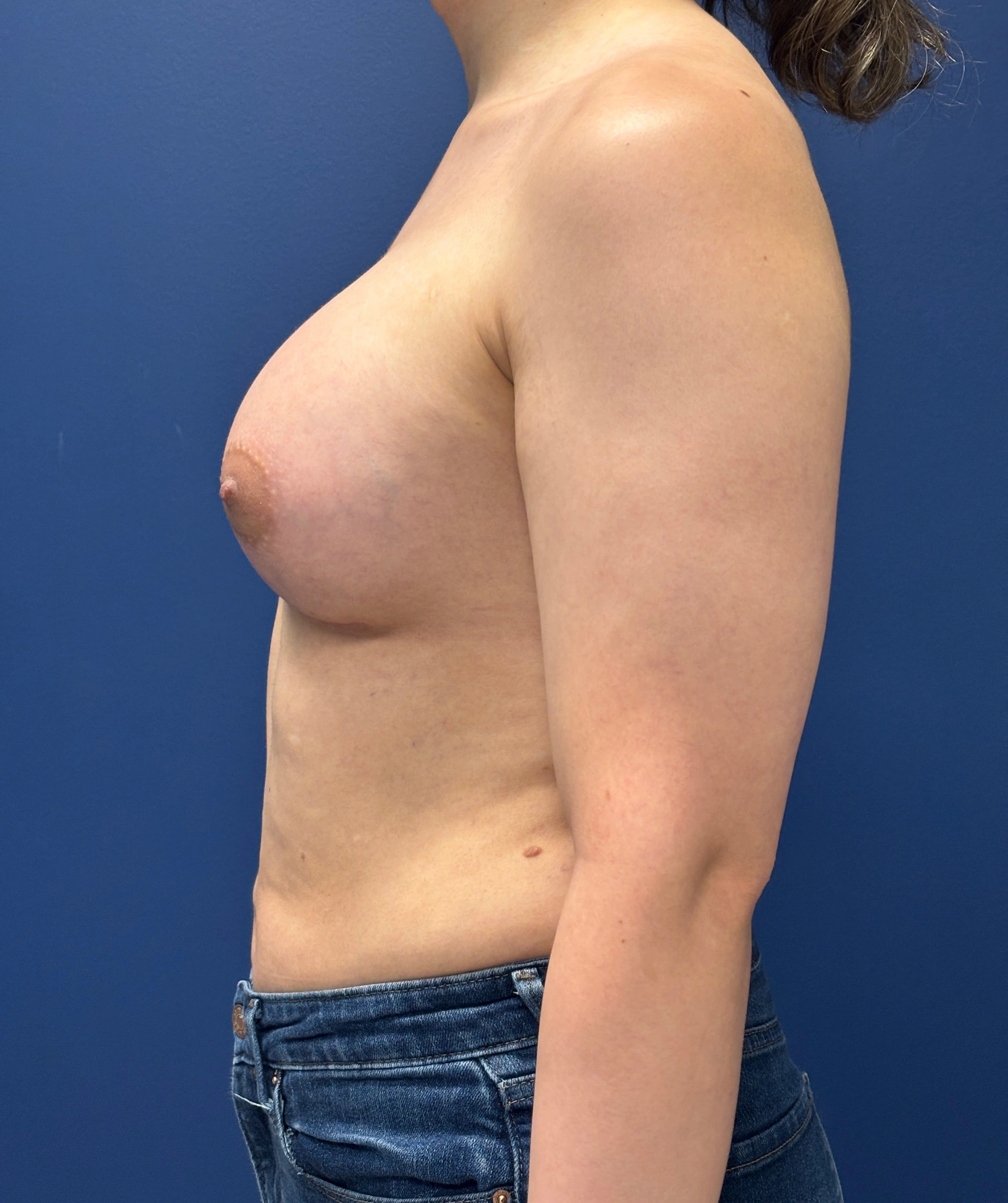 Breast-Augmentation-Case--2719 | After Breast 2
