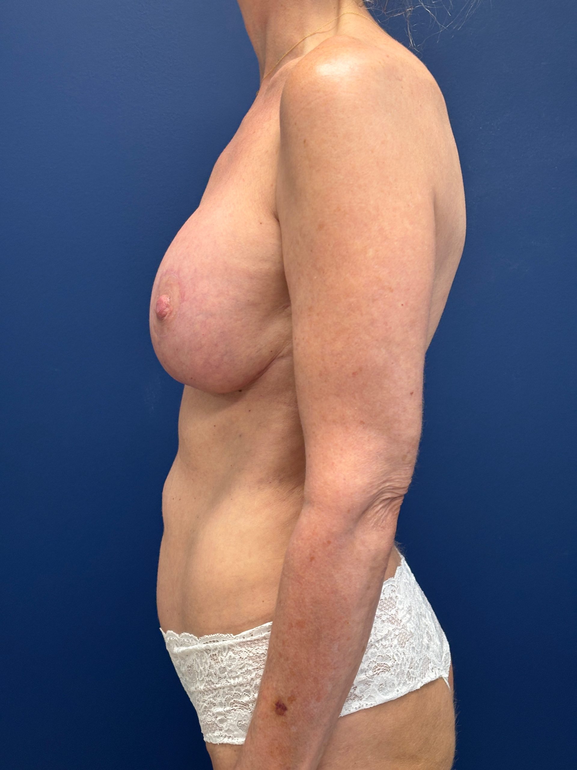 Augmentation-Mastopexy-Case--3055 | After Breast 2