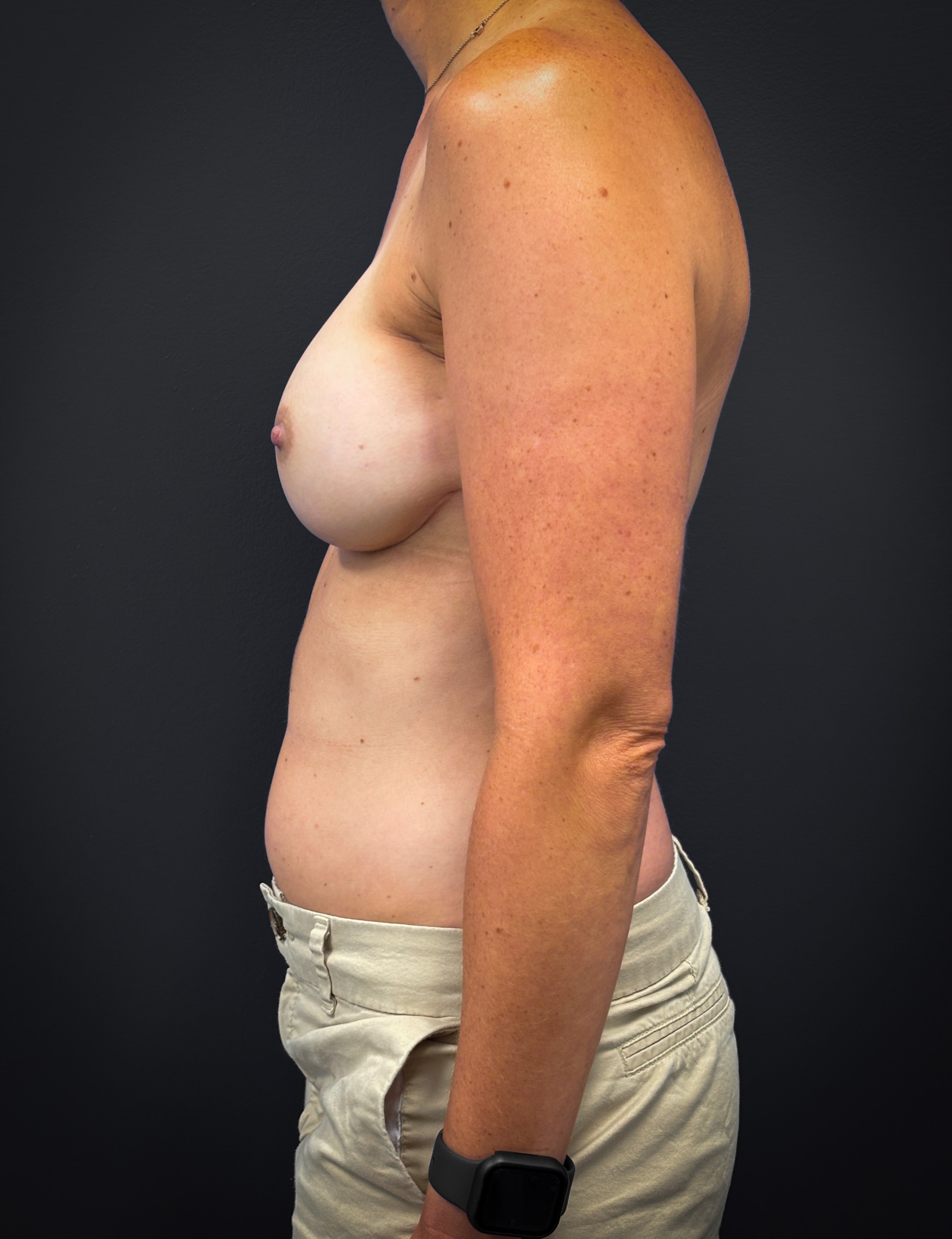 Bilateral-Mastectomy-Case--7380 | After Breast 2