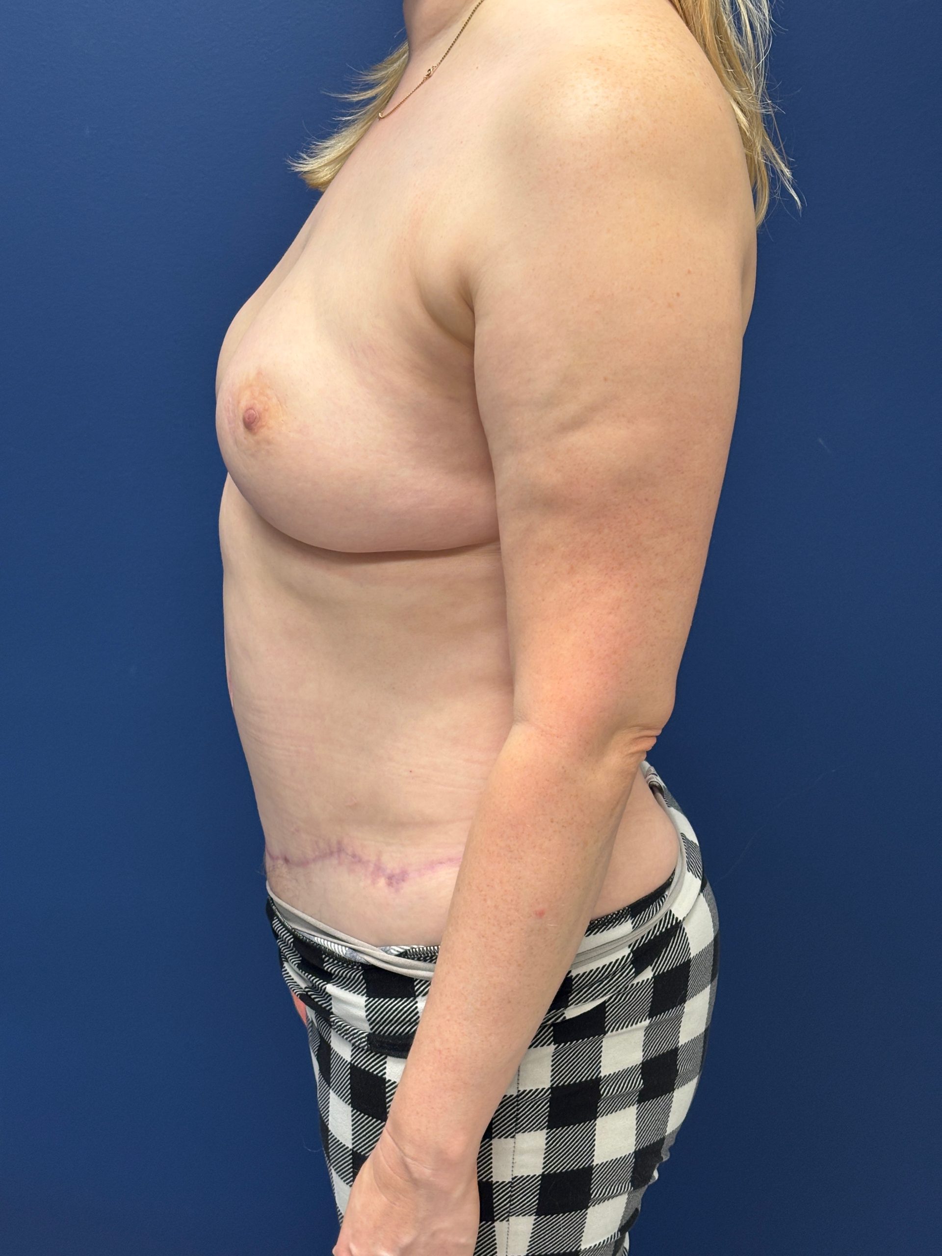 Revision-Breast-Reconstruction-Case--9545 | After Breast 2