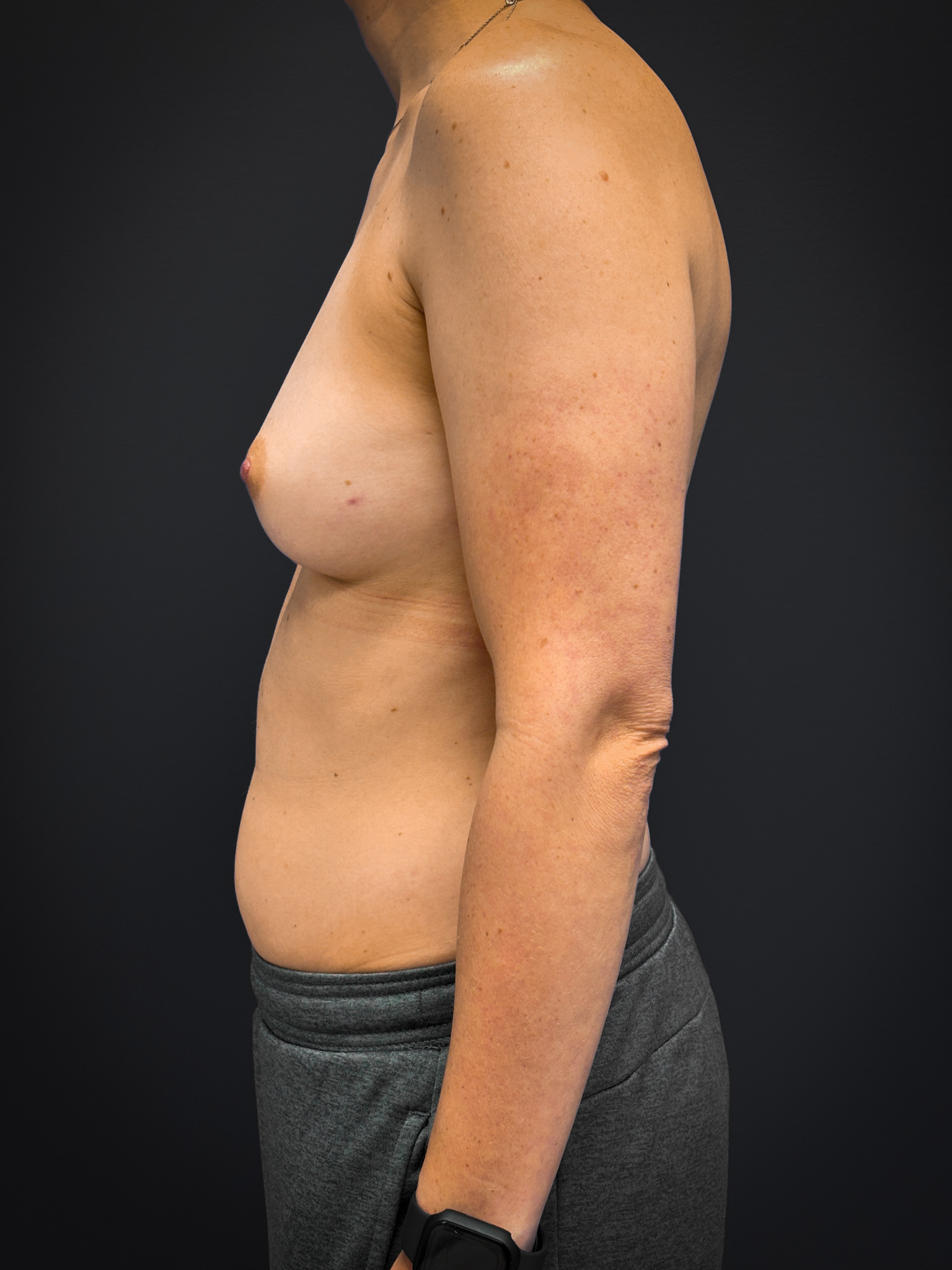 Bilateral-Mastectomy-Case--7380 | Before Breast 2