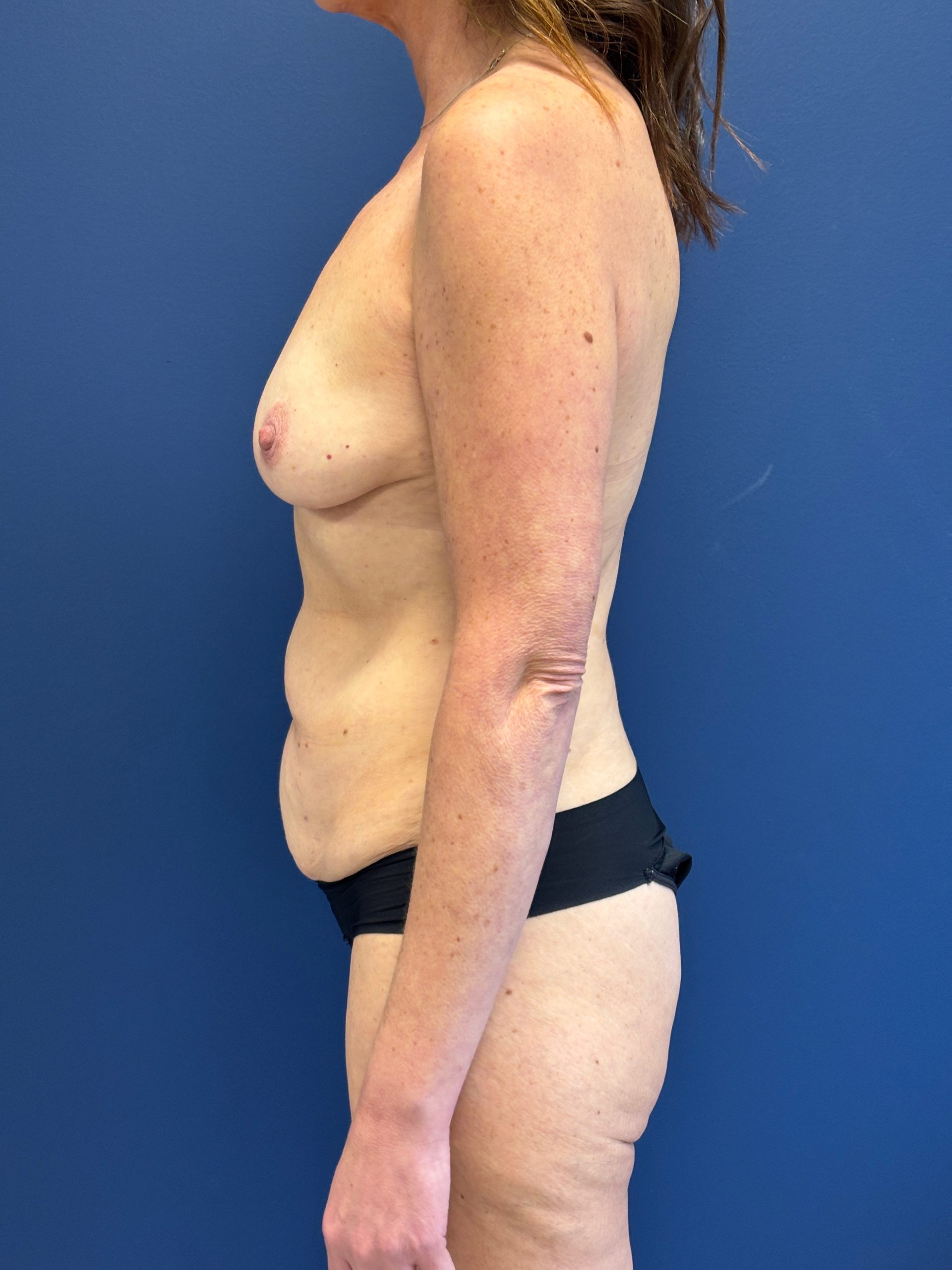 Breast-Augmentation-Case--3669 | Before Breast 2