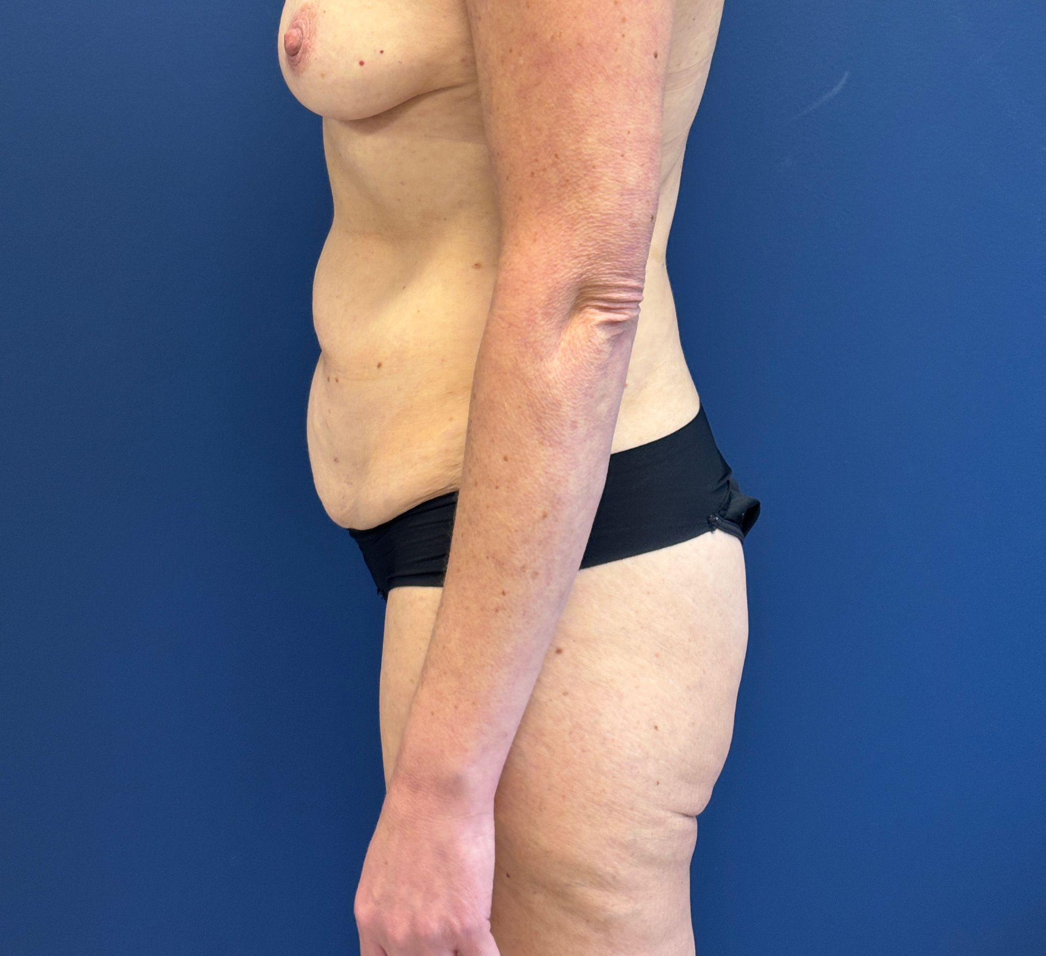 Liposuction-Case--3054 | Before Liposuction 2