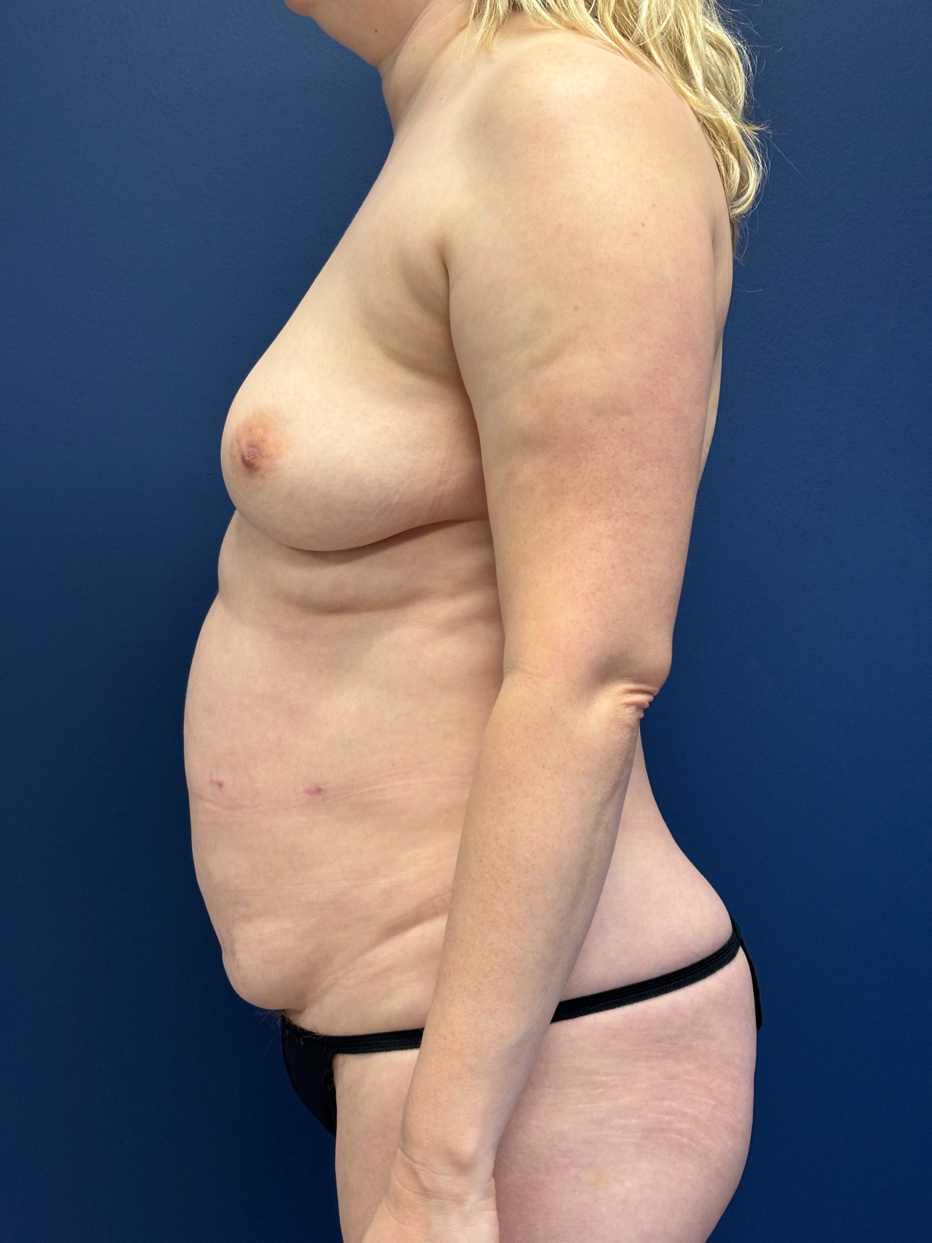 Revision-Breast-Reconstruction-Case--9545 | Before Breast 2