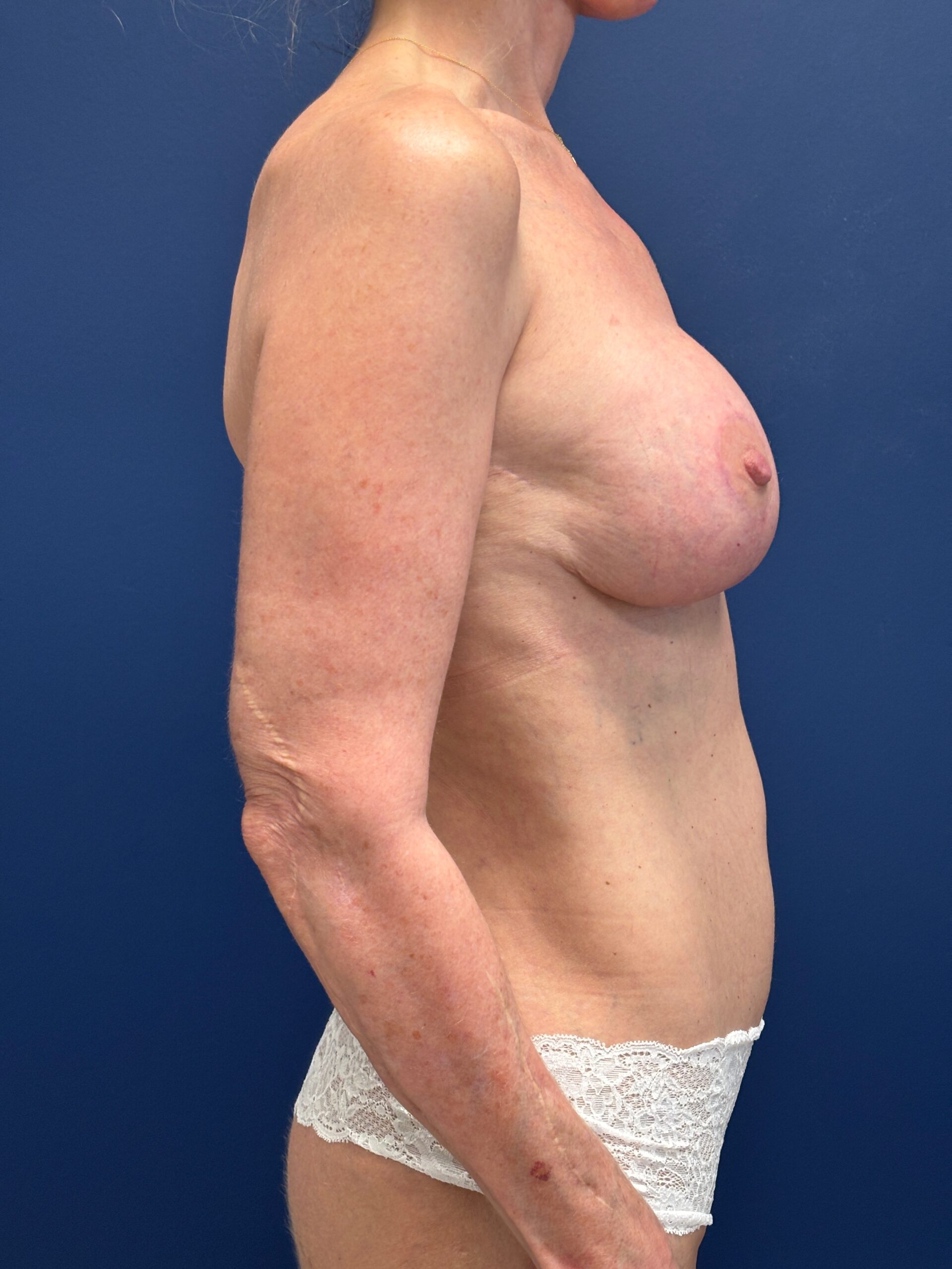 Augmentation-Mastopexy-Case--7491 | After Breast 2