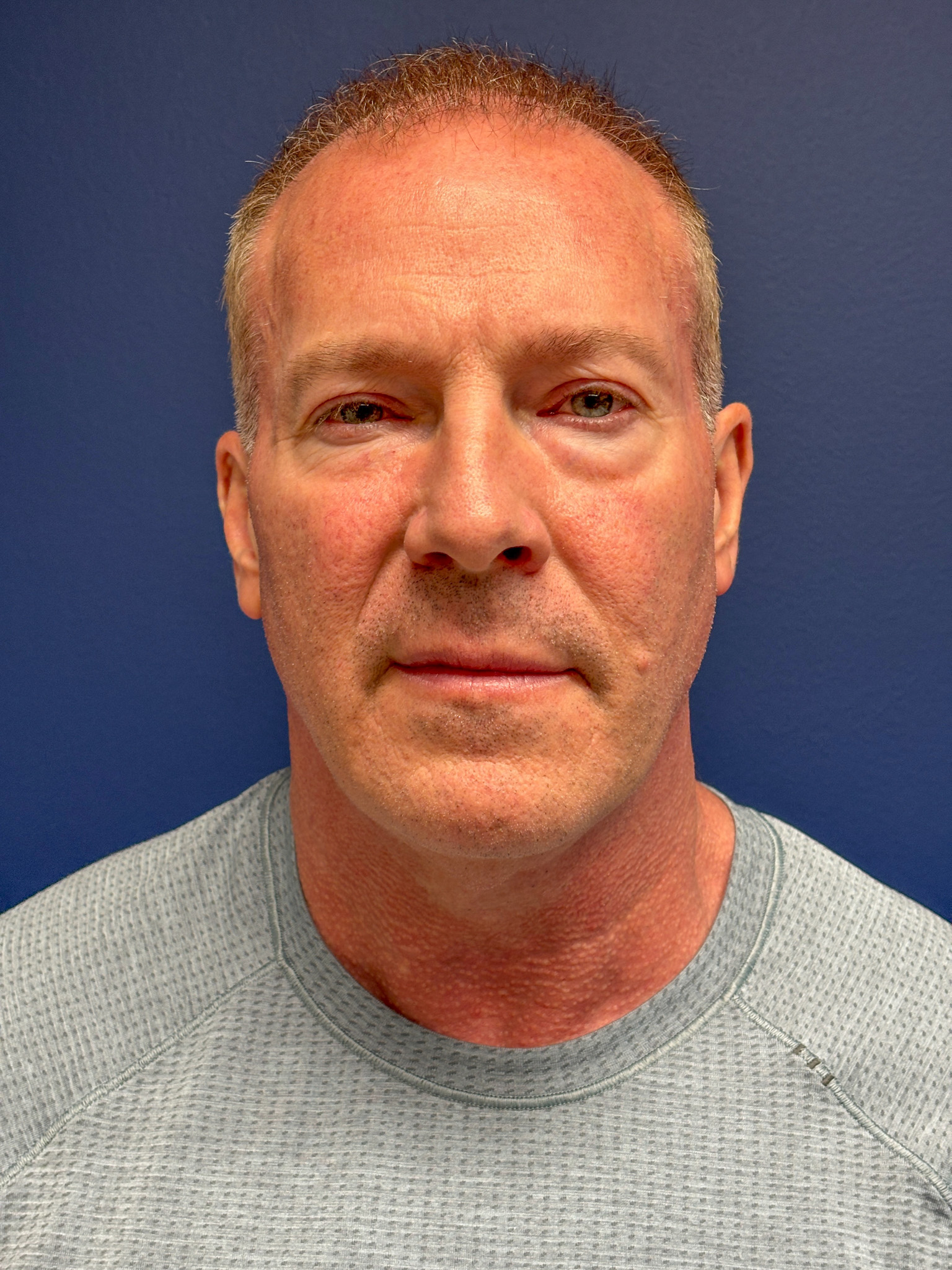 Facelift-Necklift-Blepharoplasty-Case--5535 | Before Face360 1