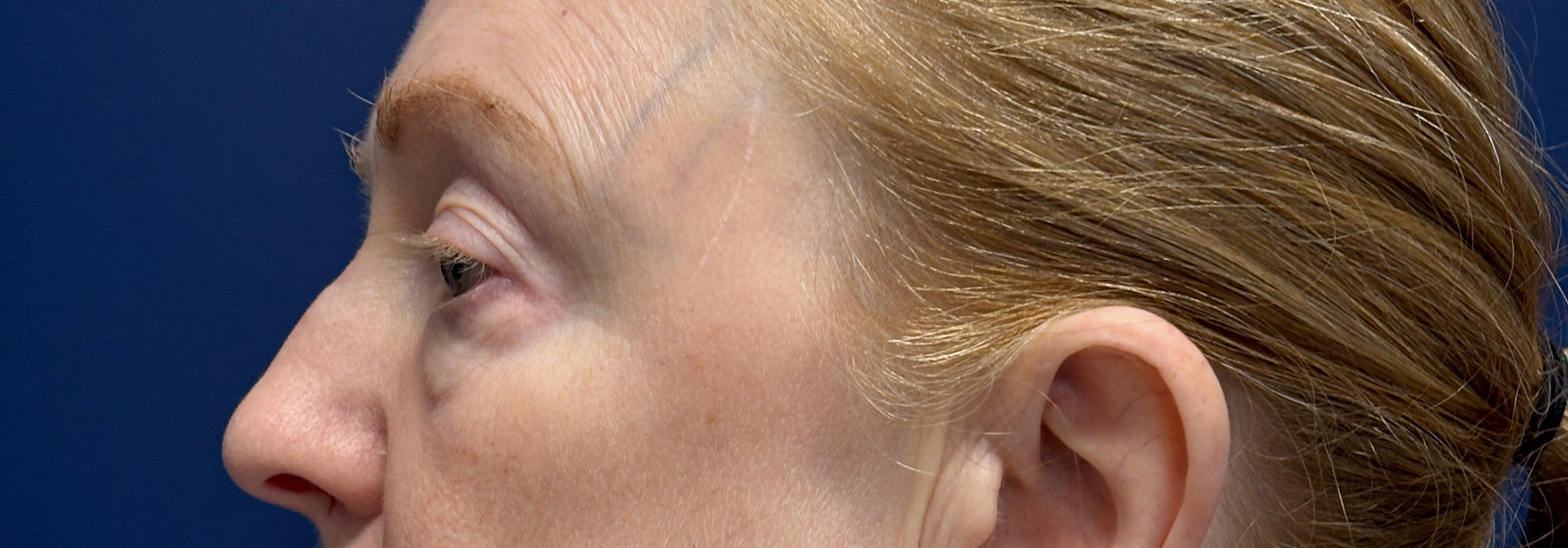 Blepharoplasty-Case--2019 | Before Eyelid Surgery 3