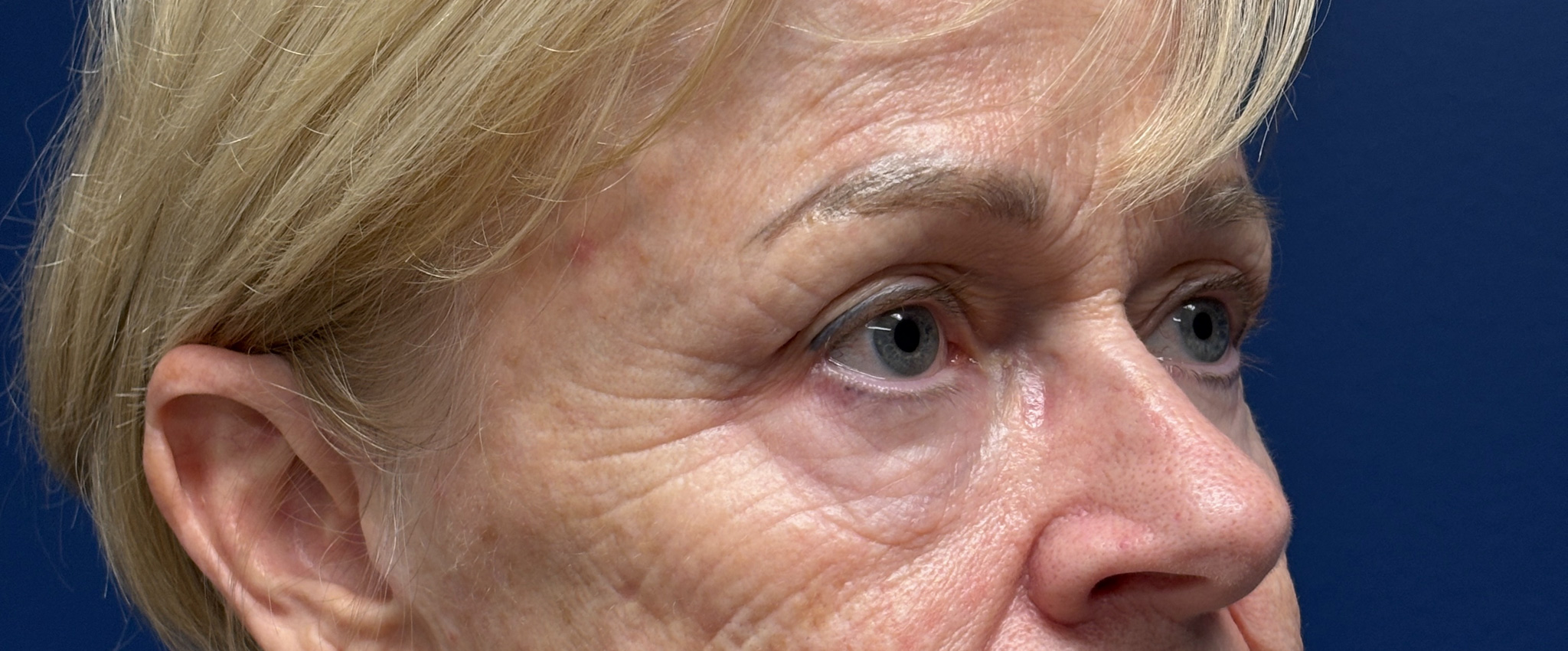 Blepharoplasty-and-Brow-Lift-Case--3108 | Before Dr. Arjun Kanuri 2