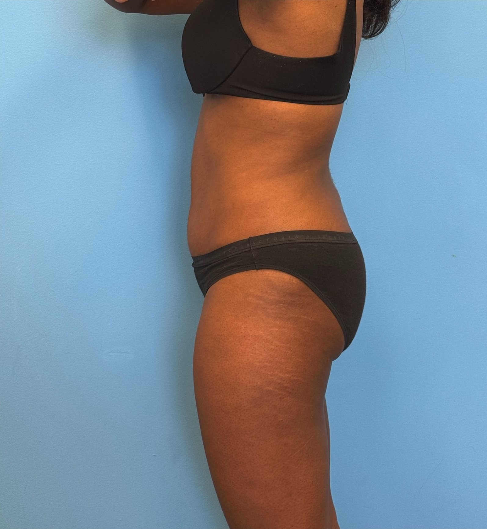 Abdominoplasty-Case--28134 | After Tummy Tuck 3