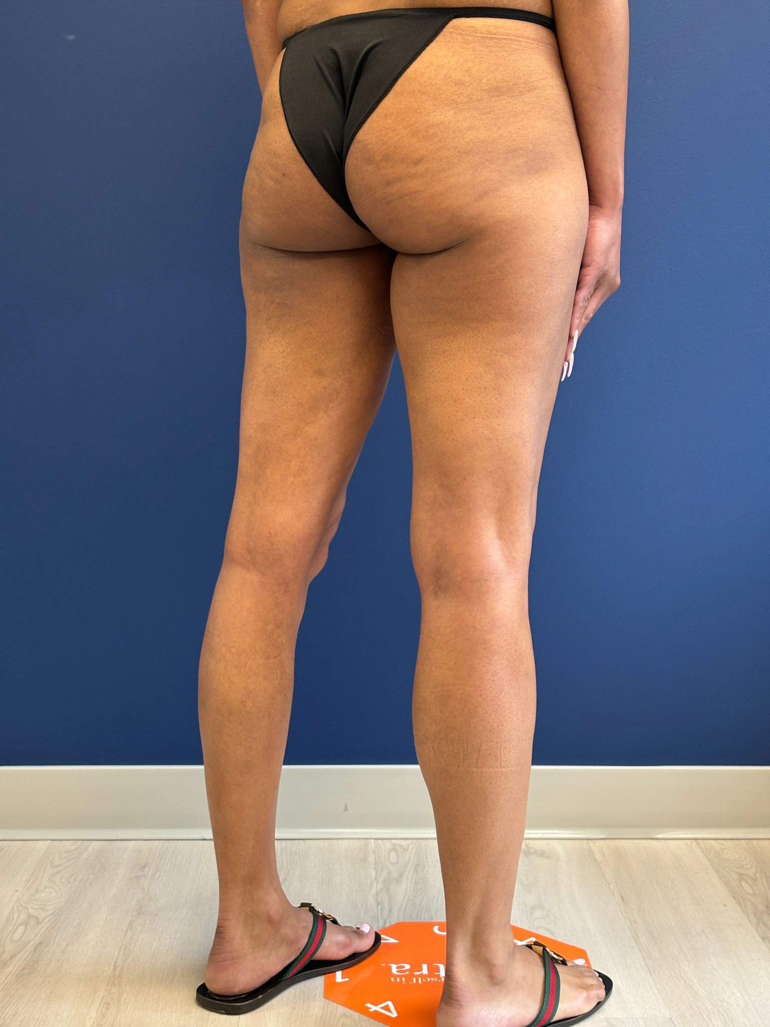 Lipo-360-Case--8130 | Before Liposuction 10