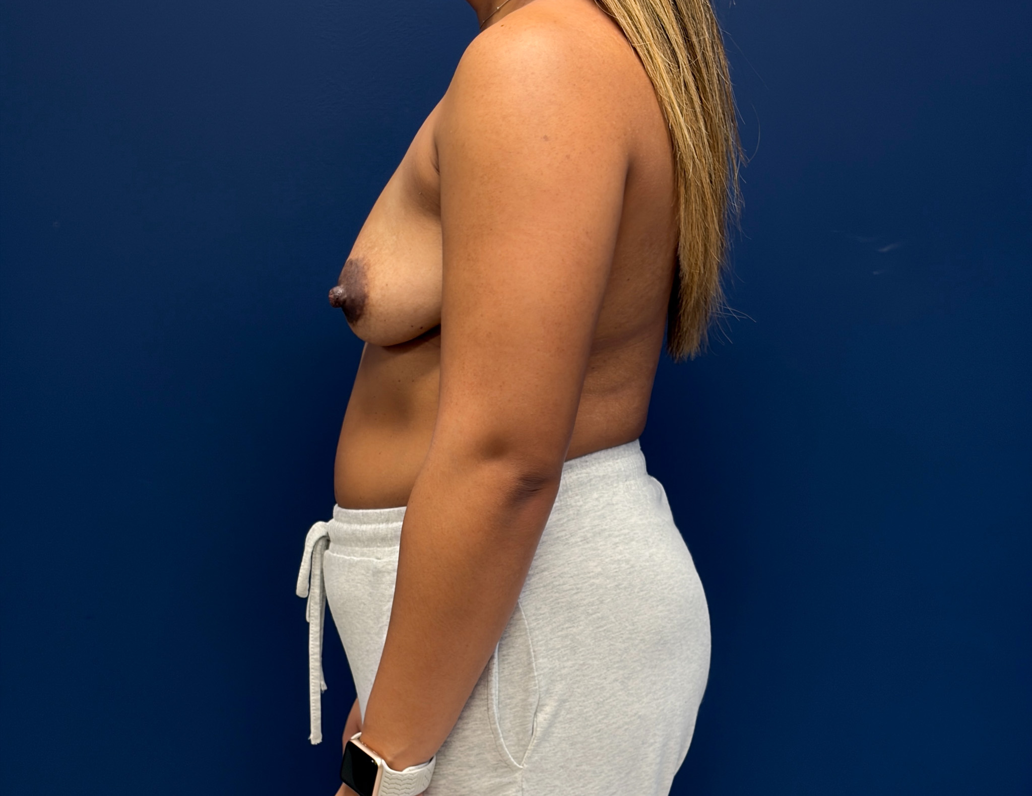 Breast-Augmentation-Case--3666 | Before Breast 2