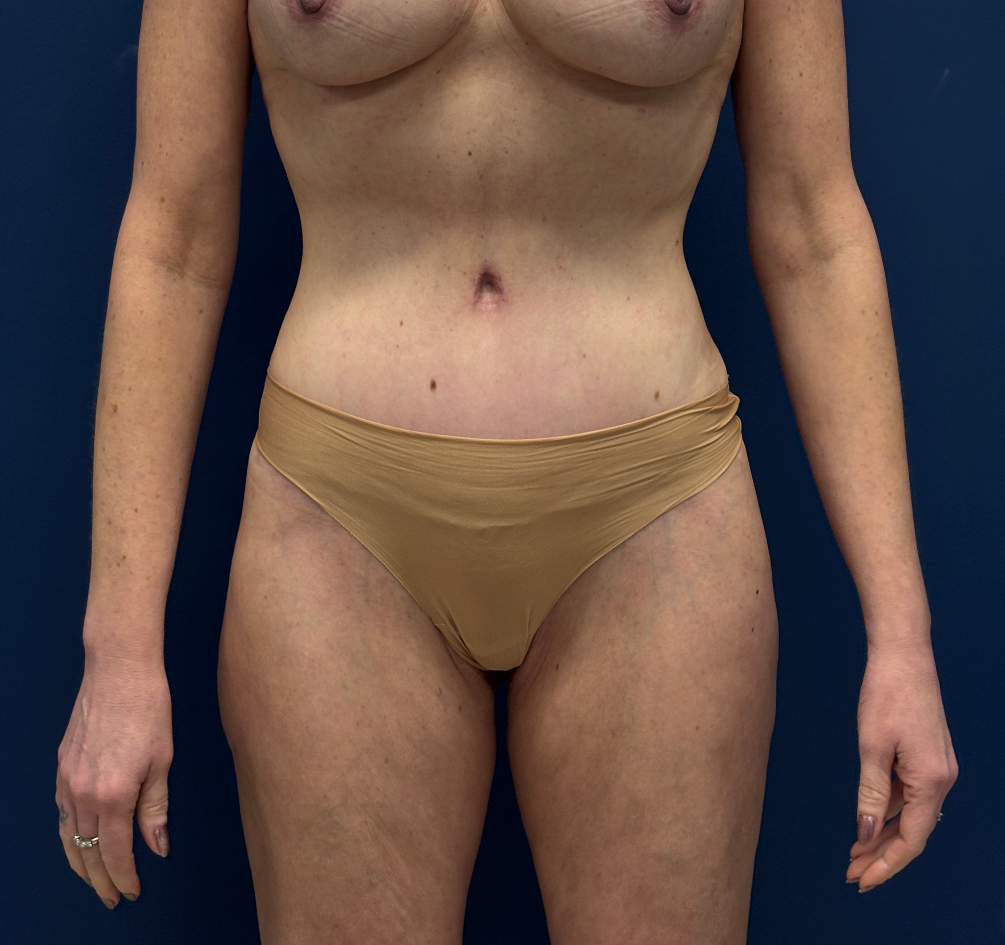 Liposuction-Case--3054 | After Liposuction 1