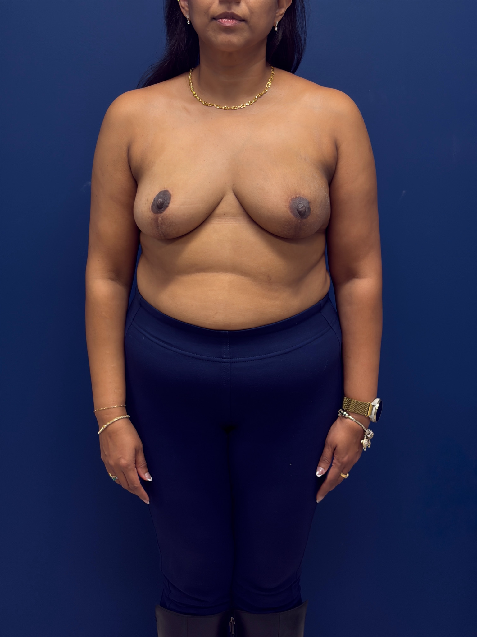 Left-Oncoplastic-Right-Reduction-Breast-Reconstruction-Case--9659 | After Breast 1