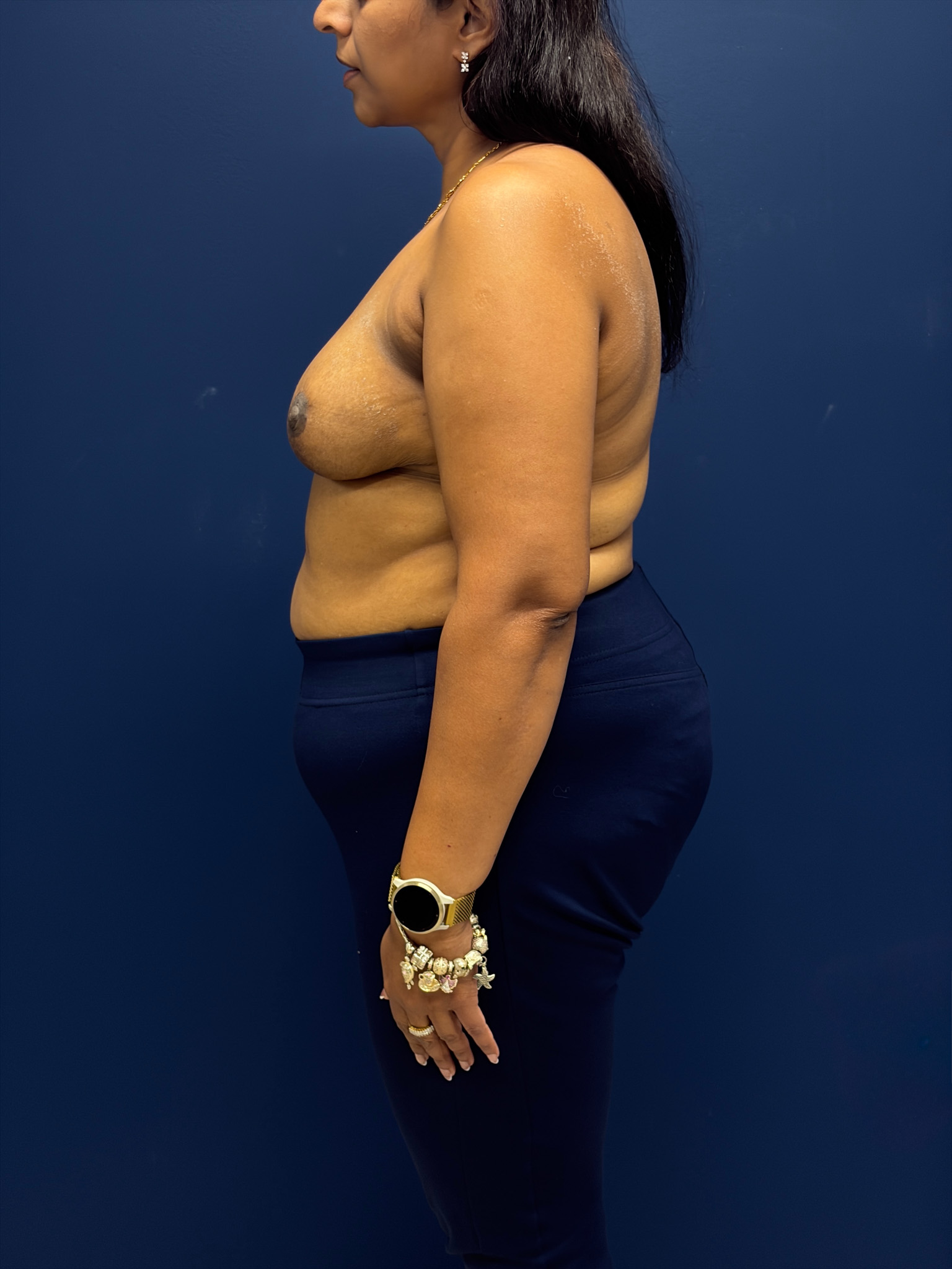 Left-Oncoplastic-Right-Reduction-Breast-Reconstruction-Case--9659 | After Breast 2