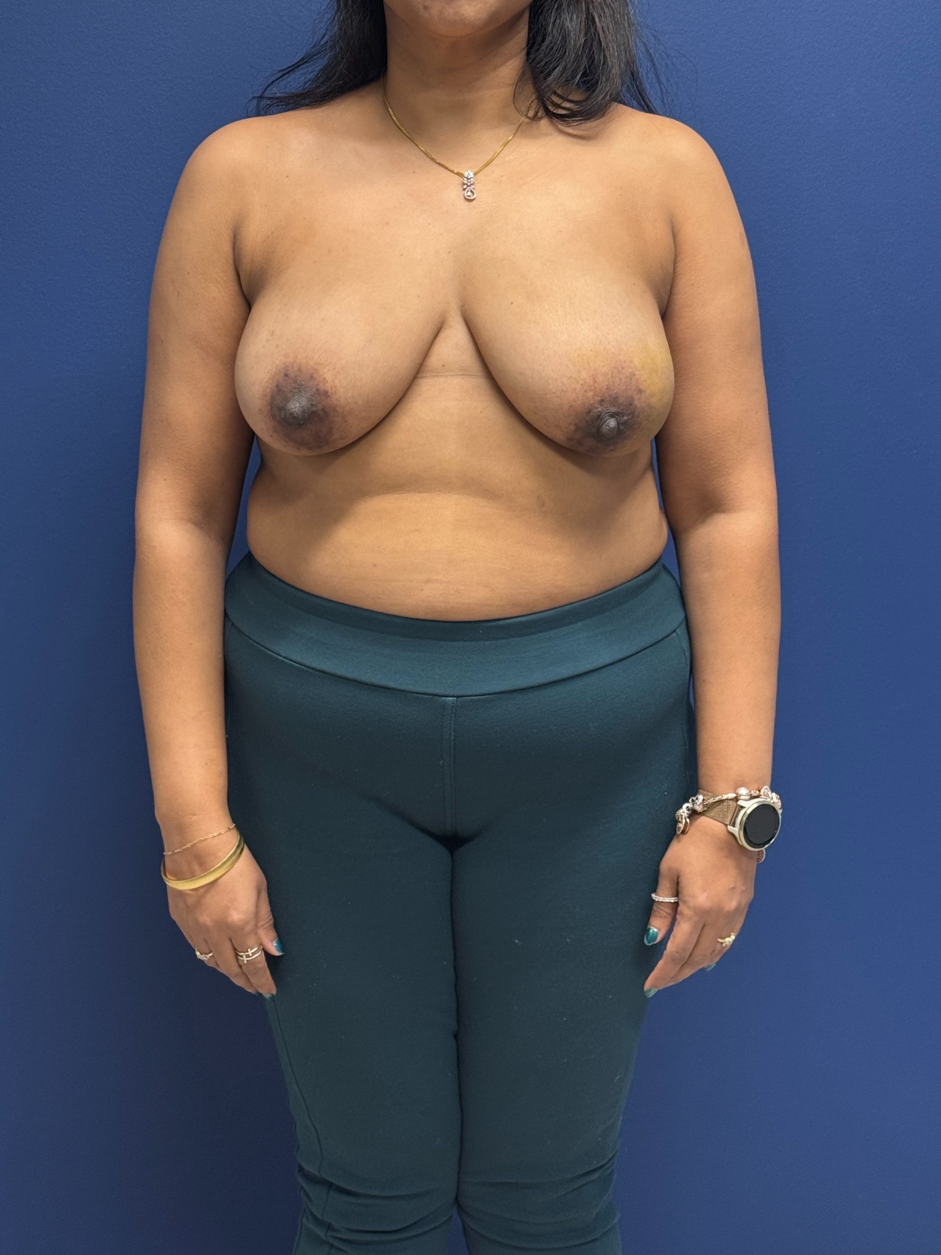 Left-Oncoplastic-Right-Reduction-Breast-Reconstruction-Case--9659 | Before Breast 1