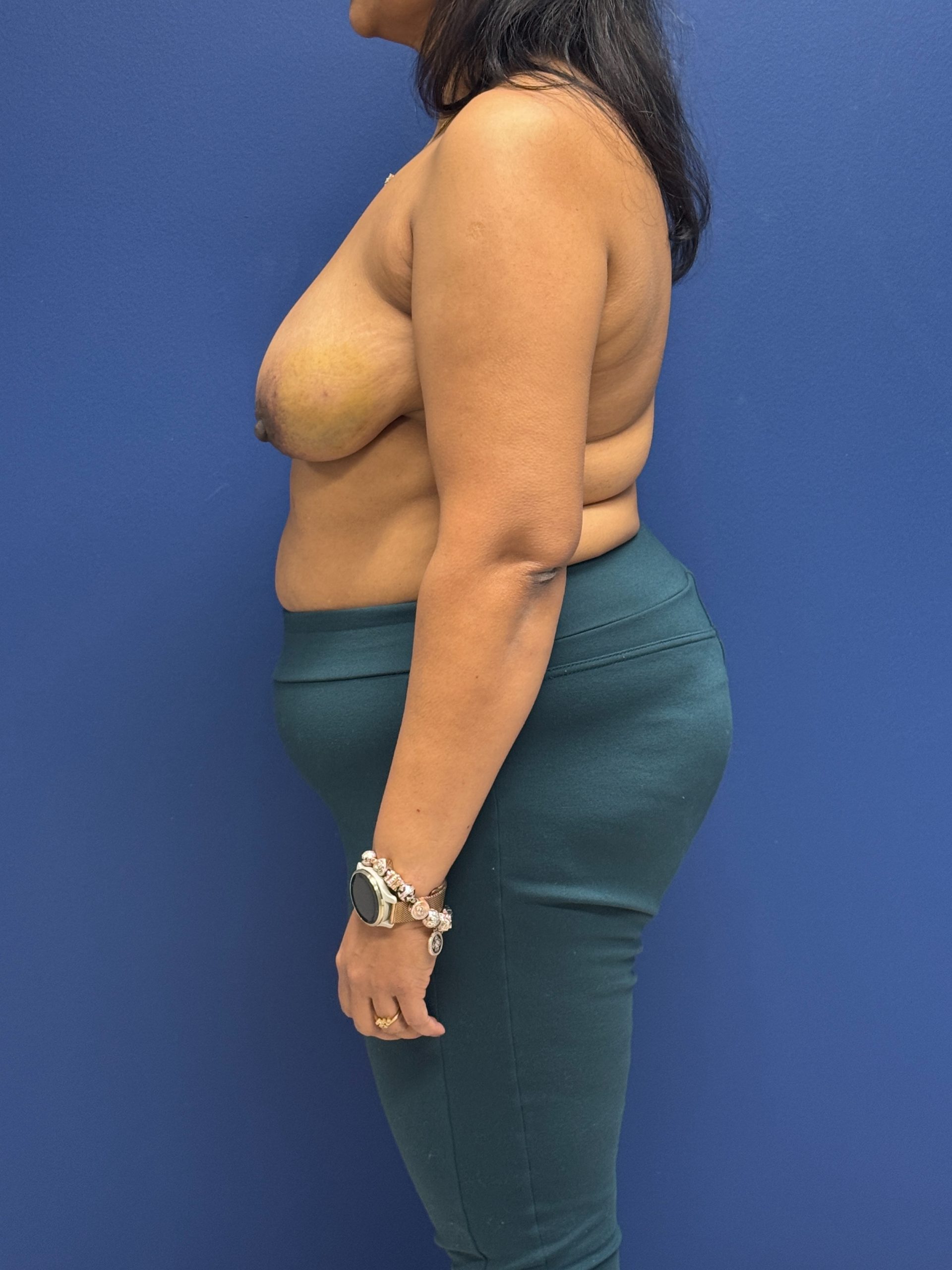 Left-Oncoplastic-Right-Reduction-Breast-Reconstruction-Case--9659 | Before Breast 2