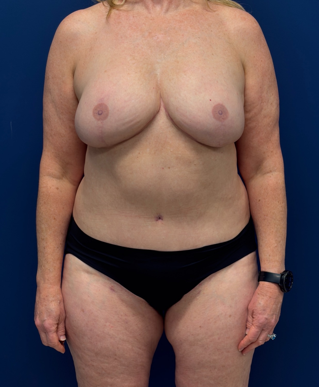 Bilateral-DIEP-Flap-Case--8499 | After Breast 1