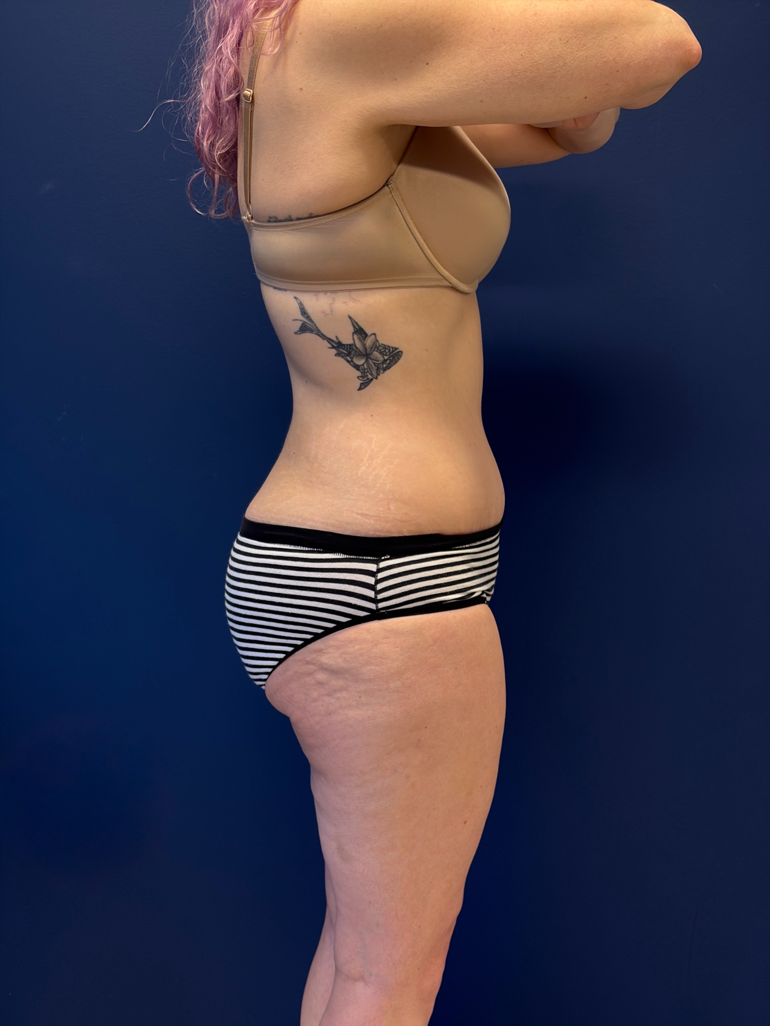 Abdominoplasty-Case--1856 | After Tummy Tuck 2