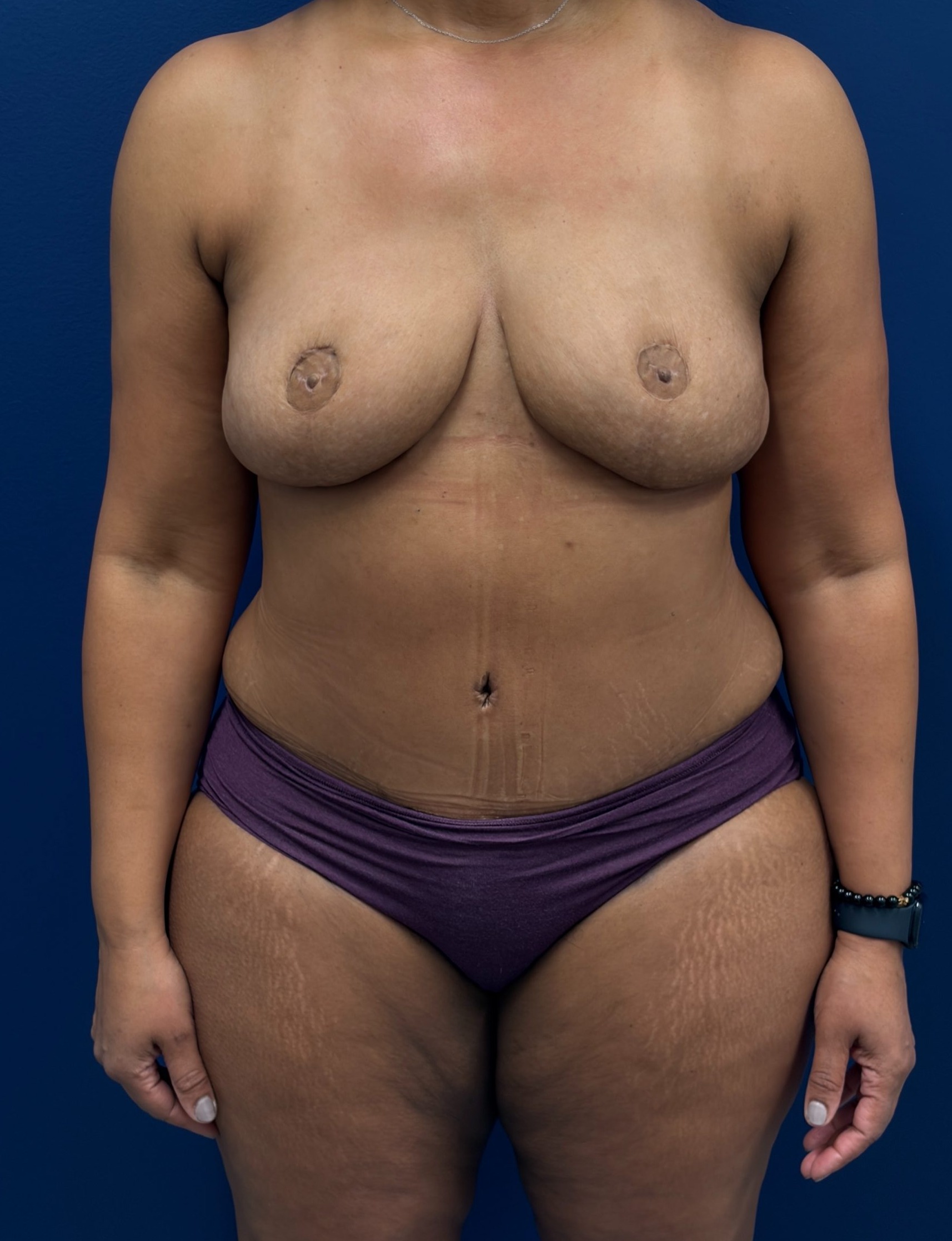Bilateral-DIEP-Flap-Case--2073 | After Breast 1