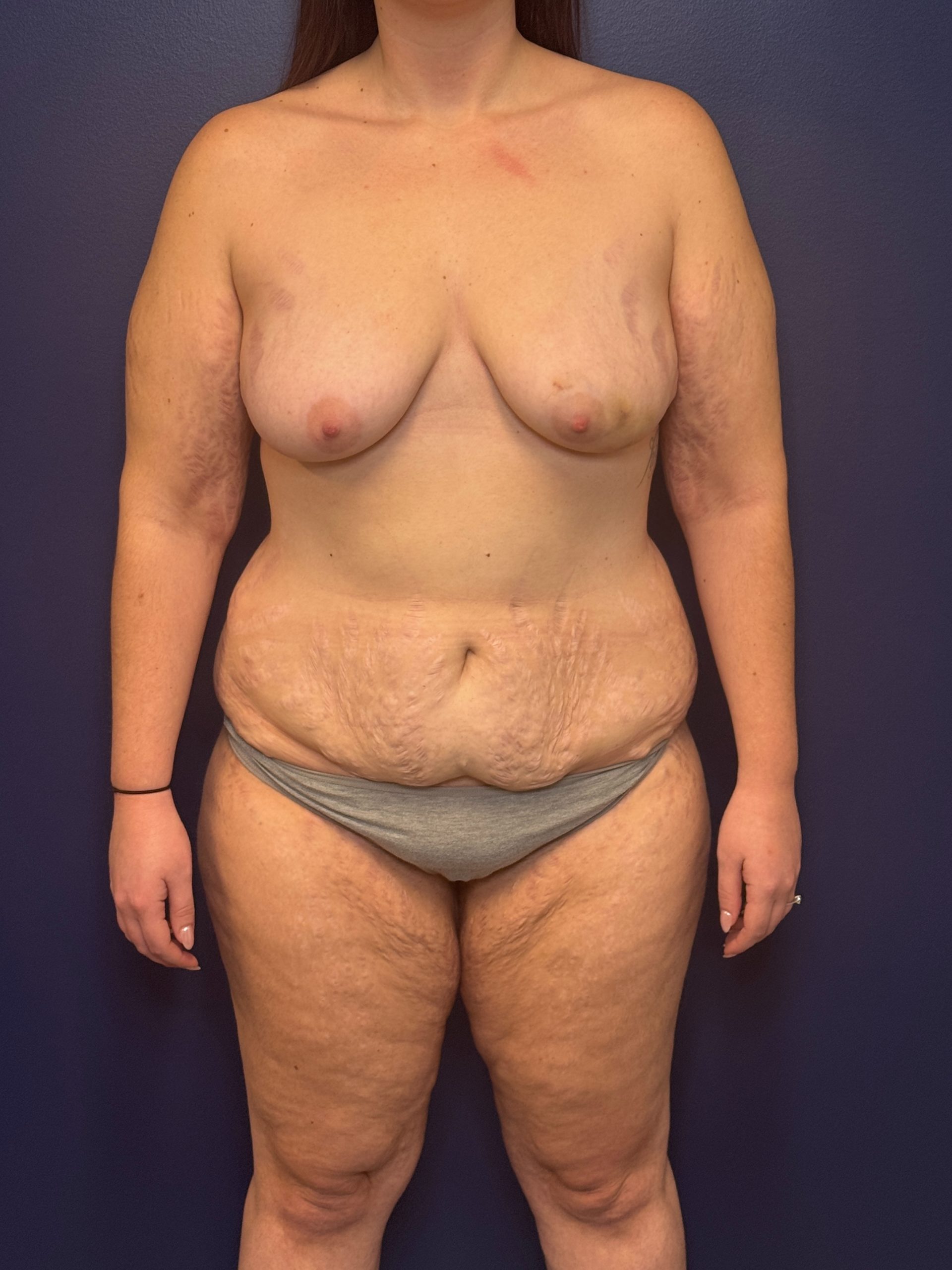 Bilateral-DIEP-Flap-Case--1108 | Before Breast 1